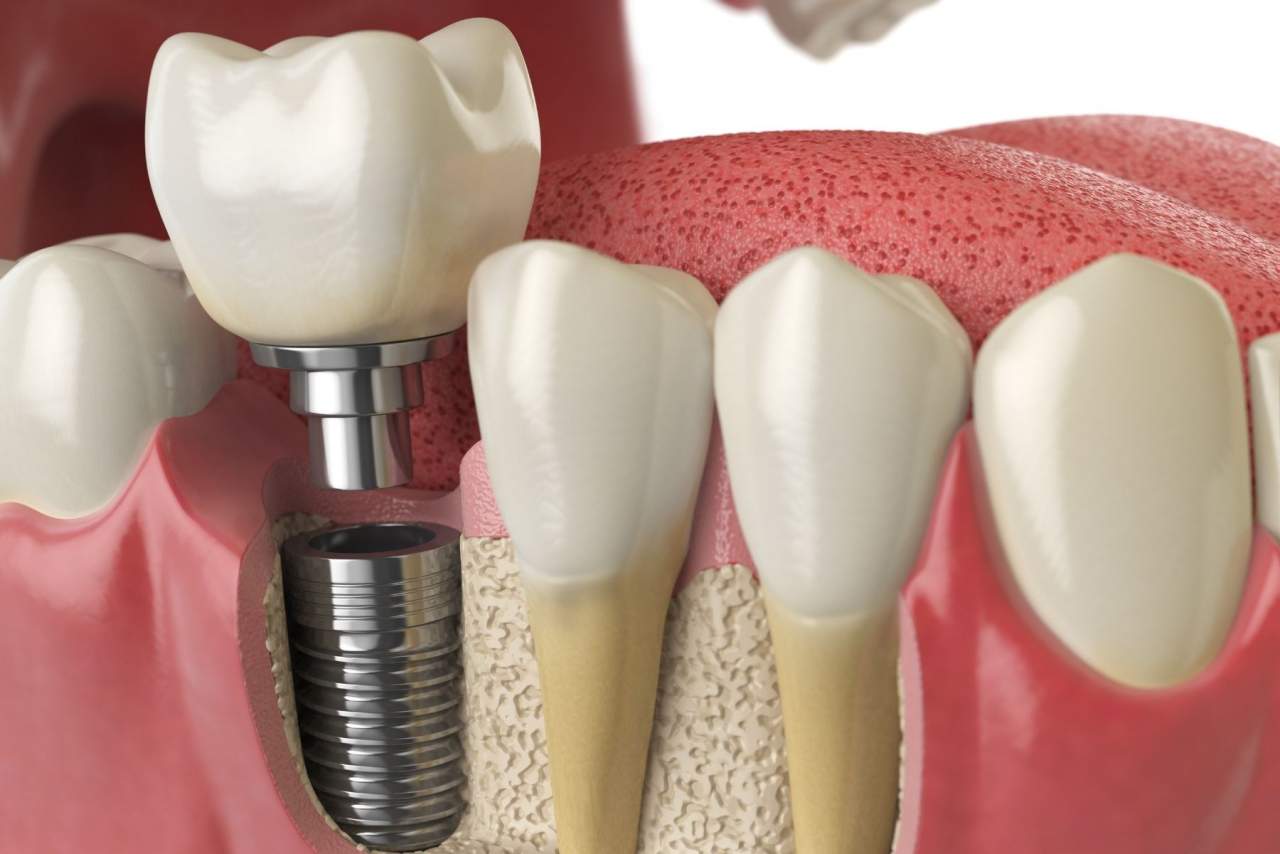 Helident Training Center: ¿Los implantes duran para siempre?¿Qué cuidados necesitan? Por Helident Training Center