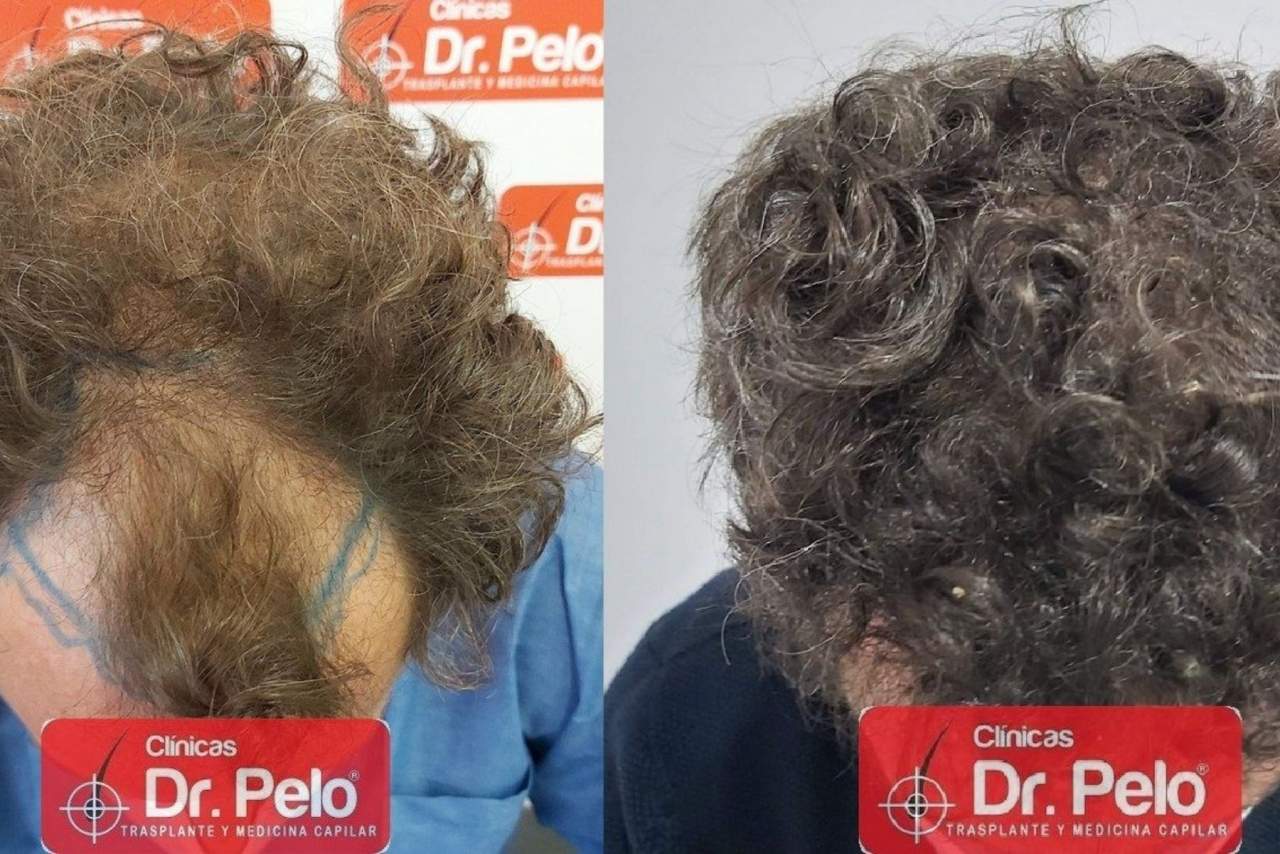 La Clínica Dr. Pelo y su injerto capilar en Sevilla