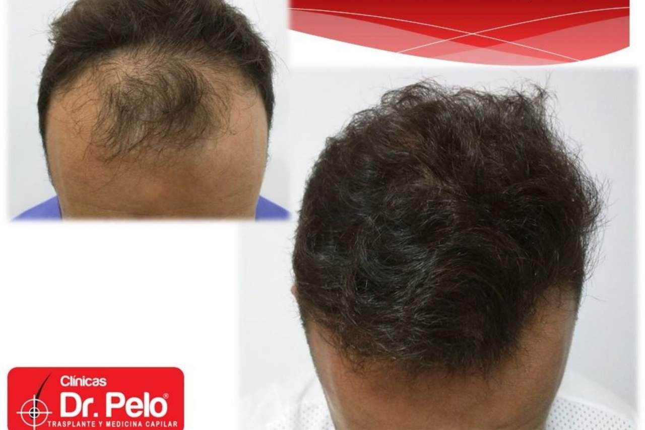 Dr. Pelo: el trasplante capilar, ¿La nueva tendencia en medicina estética?