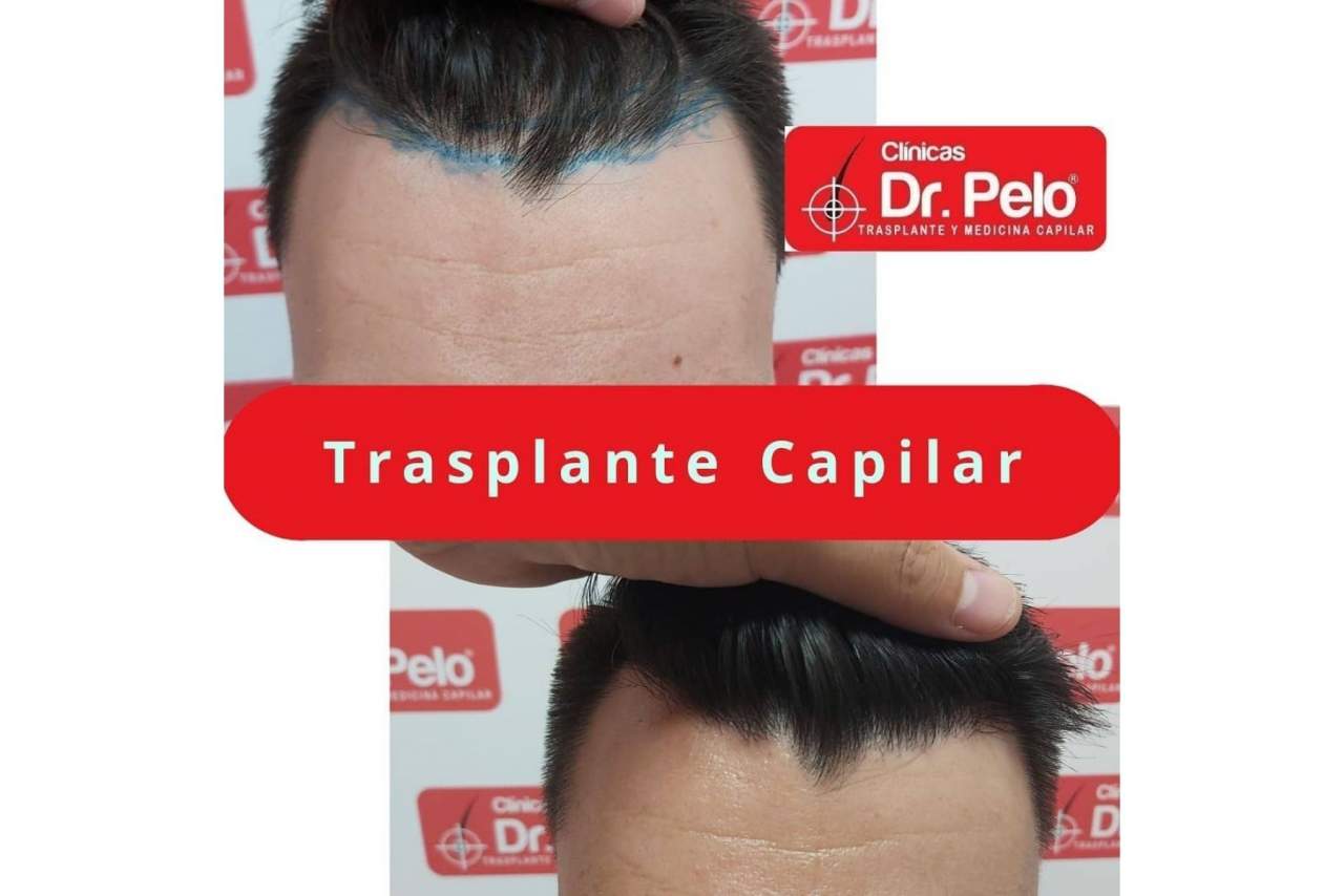 ¿Qué opinan los clientes sobre el injerto capilar de las Clínicas Dr. Pelo en Sevilla?