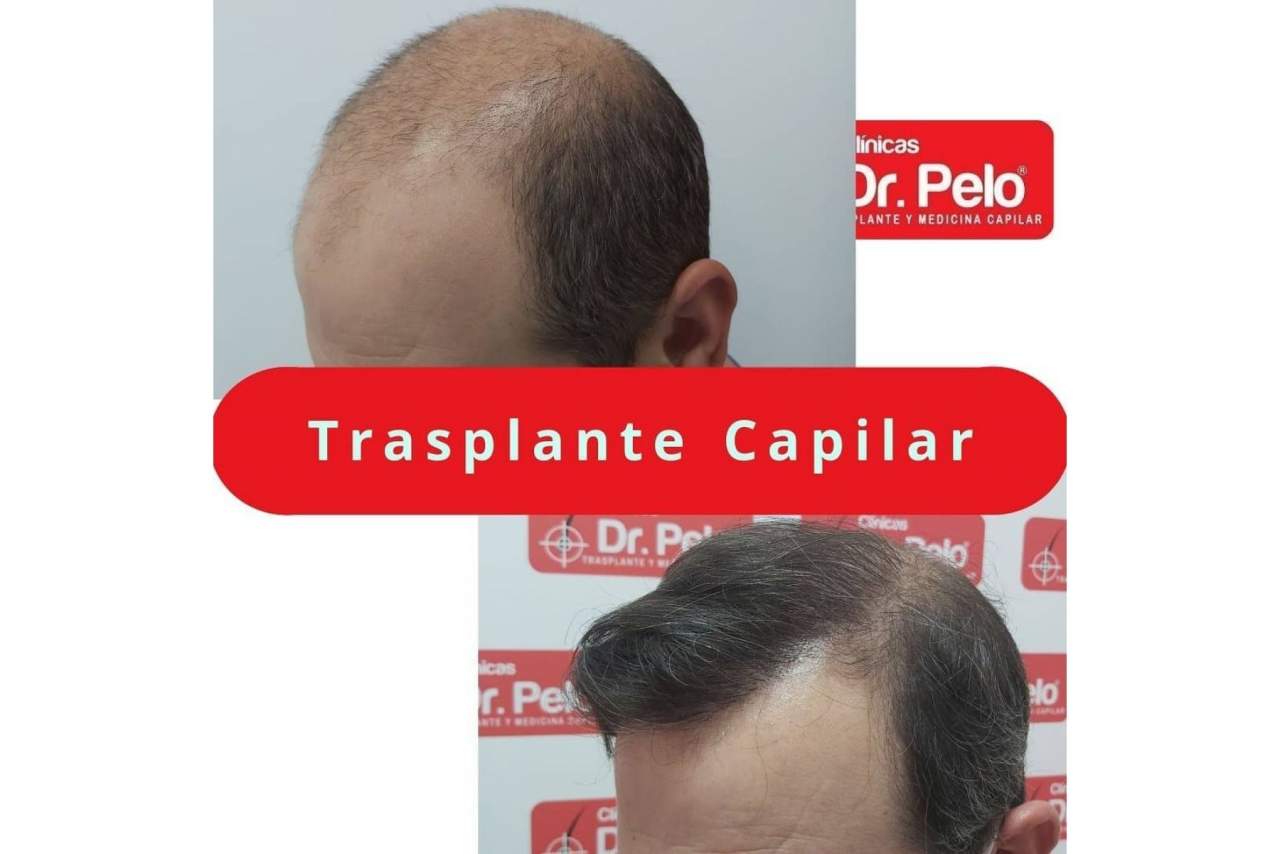 La mejora de precios y técnicas aplicadas provoca un aumento de popularidad del transplante capilar en los últimos años en España