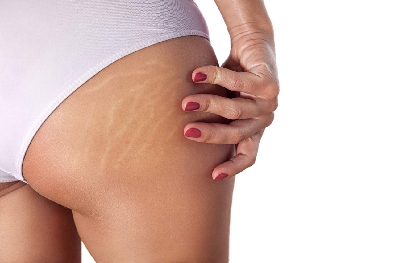 ¿Cómo quitar las estrías en la clínica Estética Alicante?