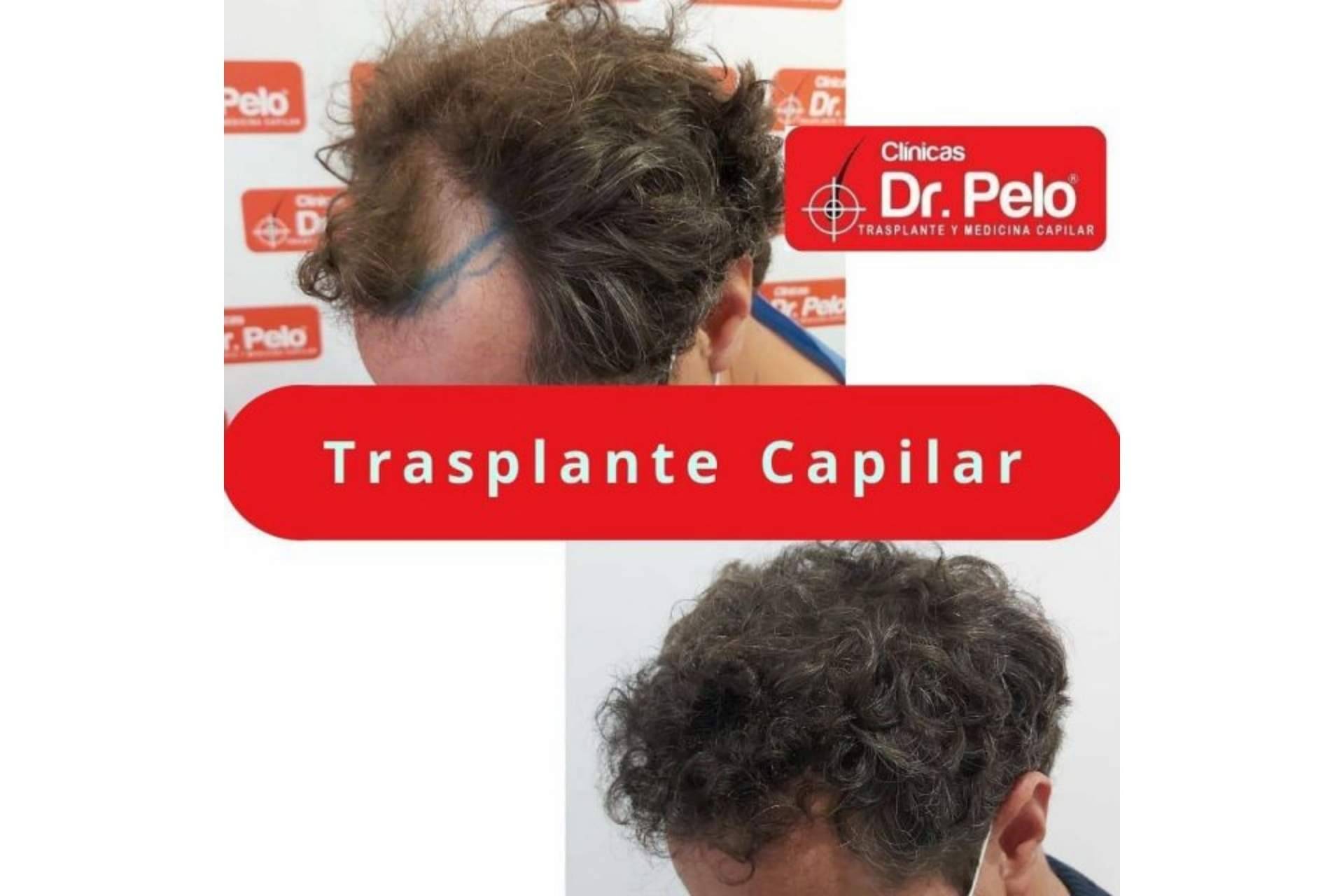 El injerto capilar en Sevilla gana popularidad gracias a las Clínicas Dr. Pelo