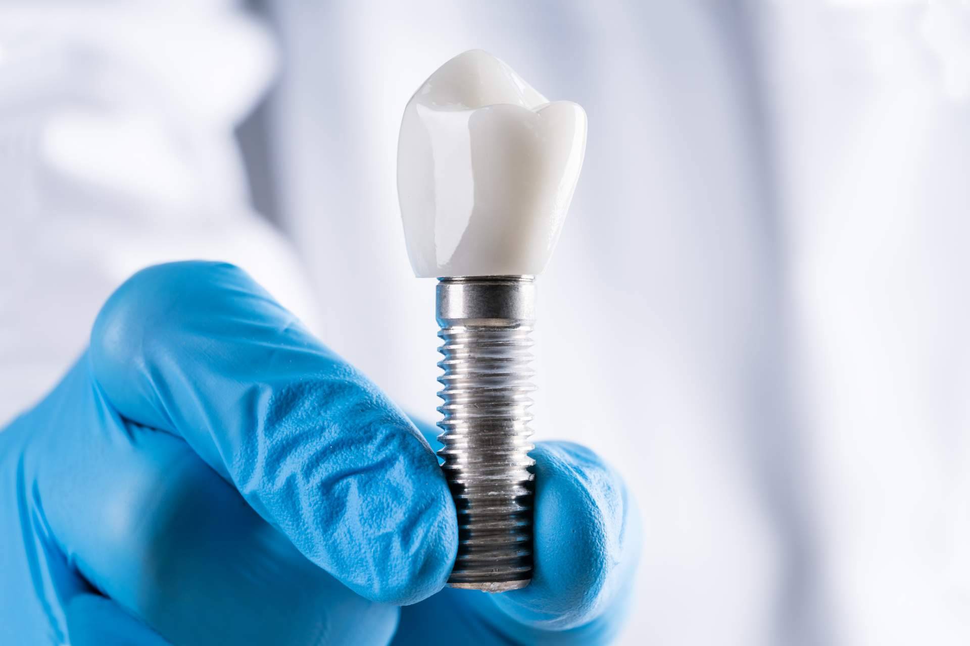 Dientes fijos en un solo día gracias a los implantes dentales de titanio V de la Clínica Artydents en Madrid