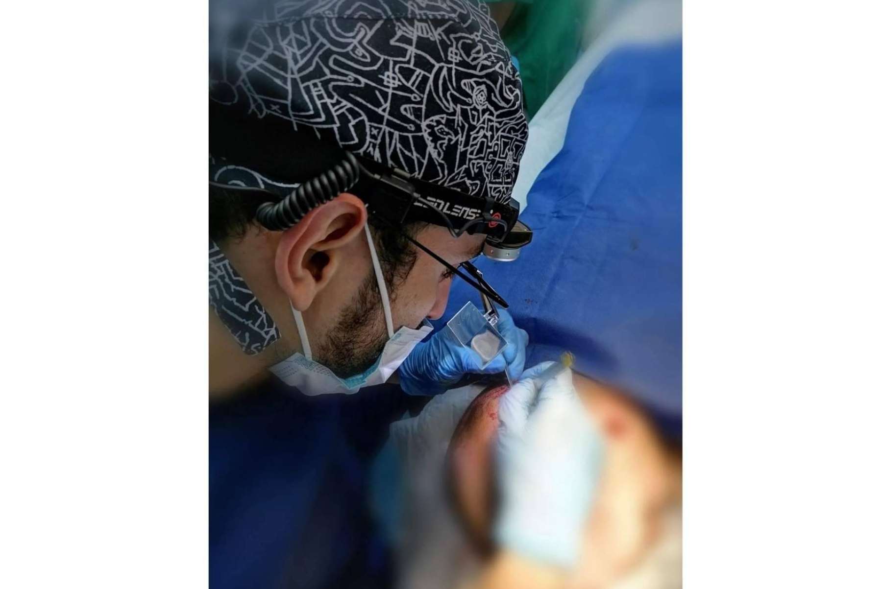 ¿Cómo se consiguen resultados naturales en el trasplante?, según el Dr. Bern