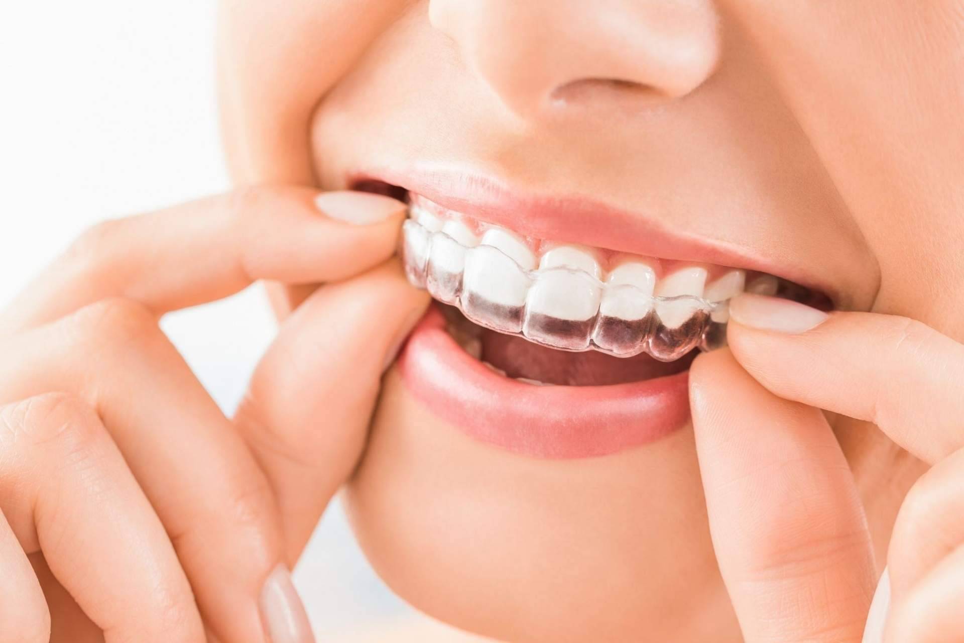 Clínica Viasalud: la estética dental y su efecto rejuvenecedor