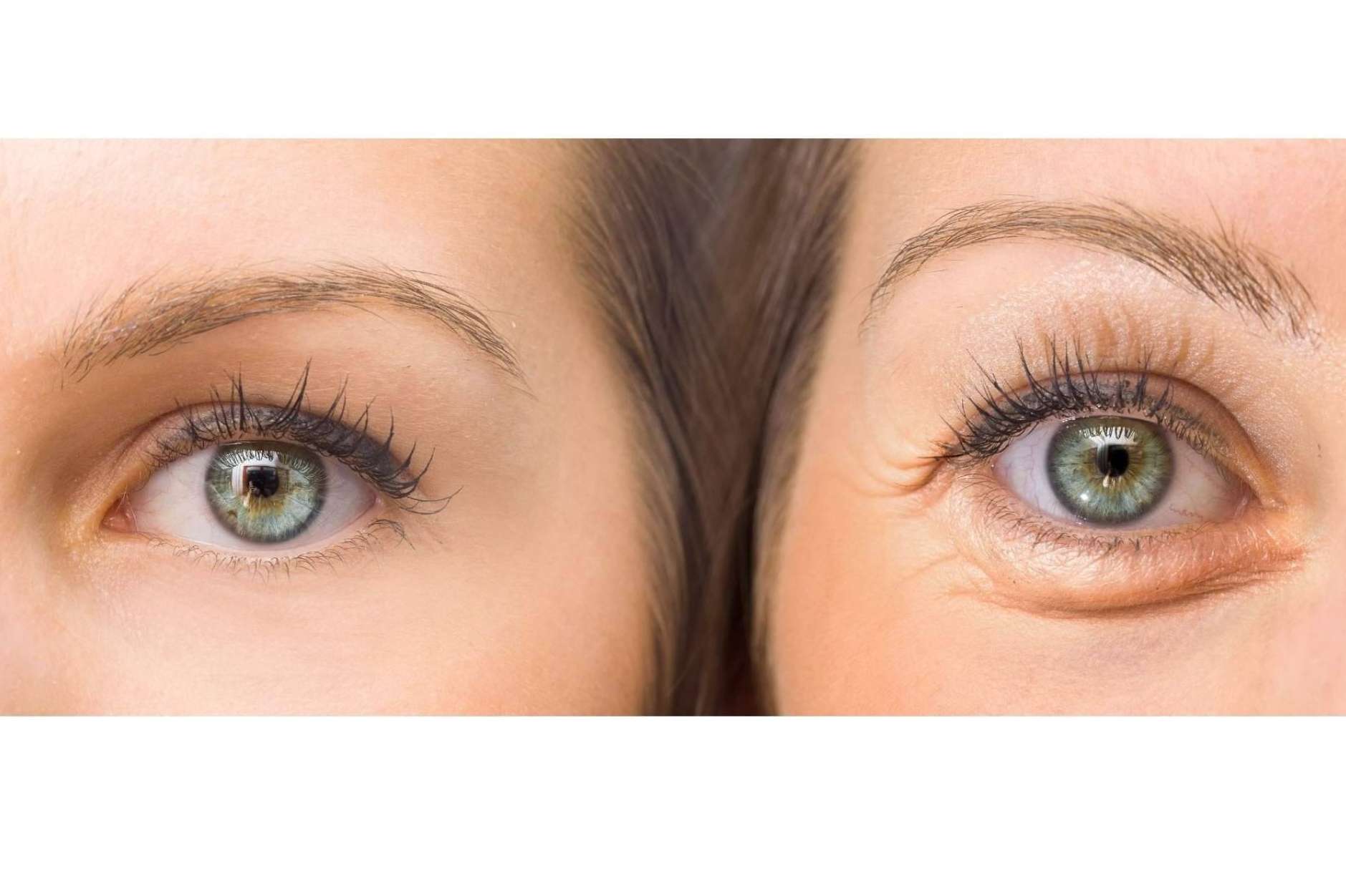 Unidad de medicina estética FEMME: ácido hialurónico para combatir las ojeras en Santiago de Compostela con la Dra. Alfonsina Uriburu