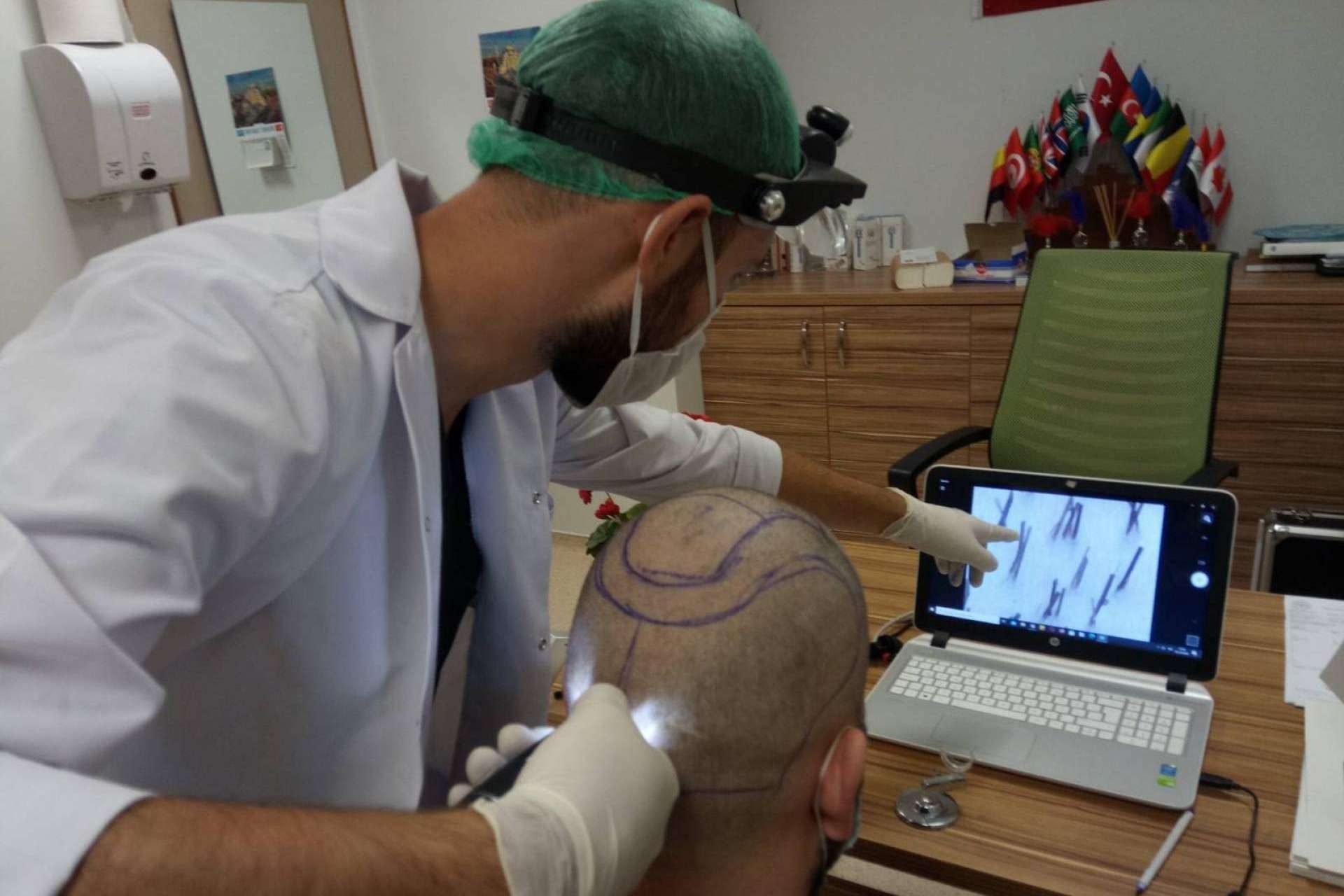 El injerto capilar Turquía todo incluido realizado por FUE Hair Transplant System