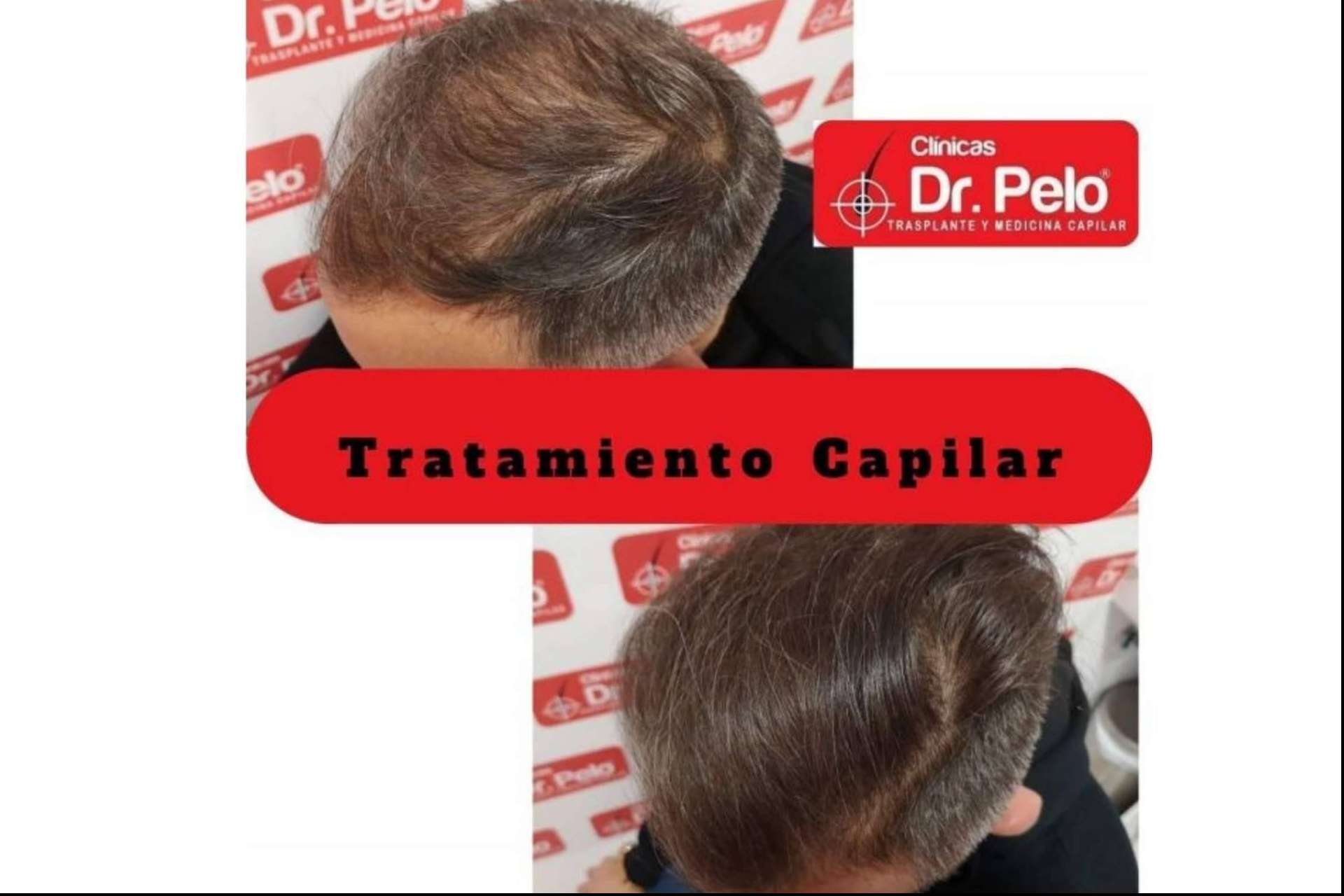 Dr. Pelo: resultados visibles con el láser capilar LedHair