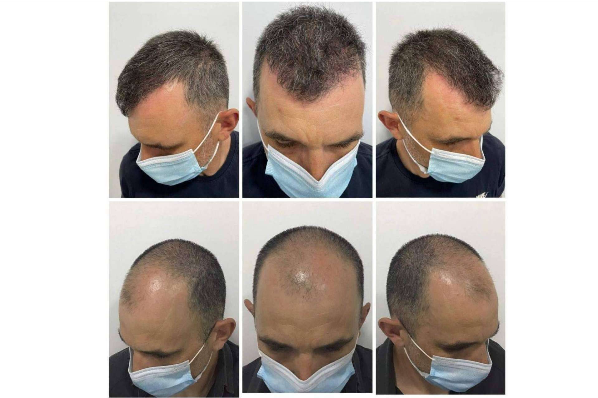 ¿En qué consiste el tratamiento de mesoterapia capilar del Dr. Bruno Jacobovski?