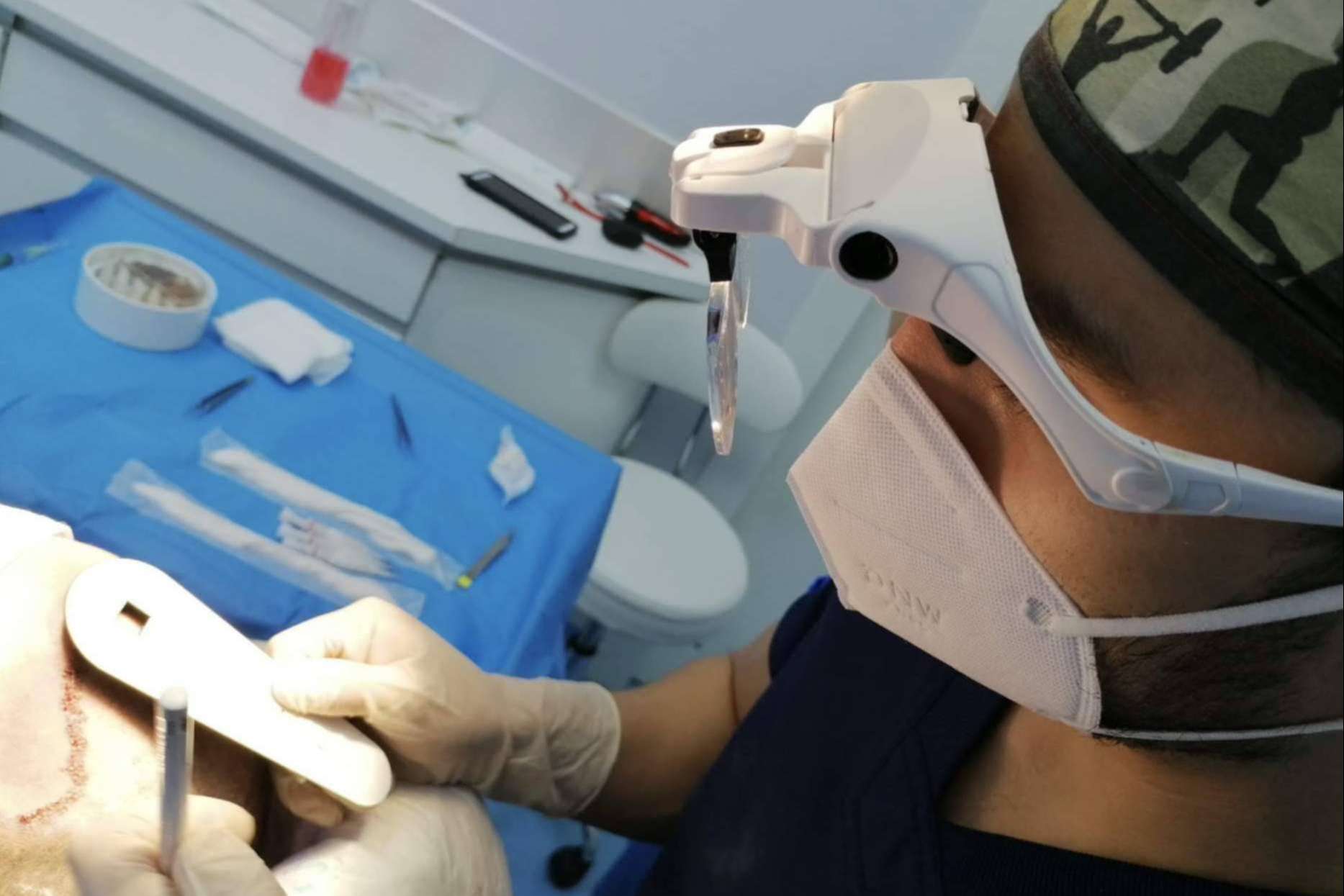 La fase del desierto capilar: ¿Cuándo se cae el pelo implantado?, por Doctor Bern