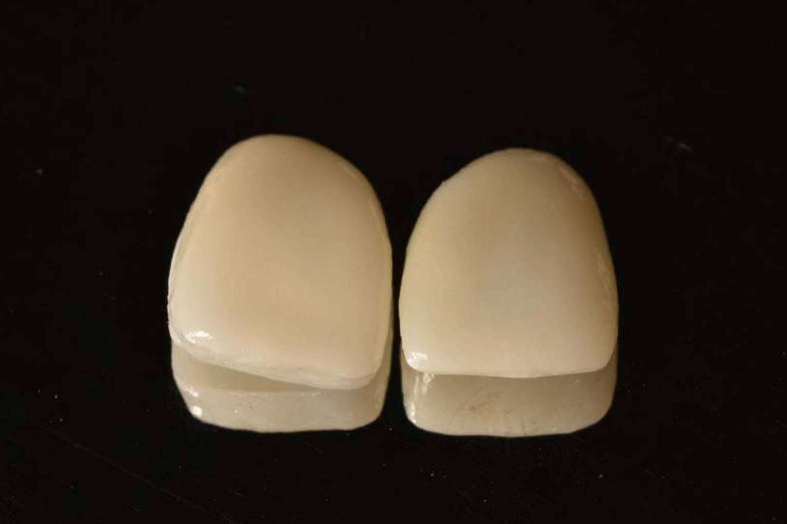 Las carillas Emax y las inyectadas de composite de Implant Clinics garantizan una sonrisa perfecta