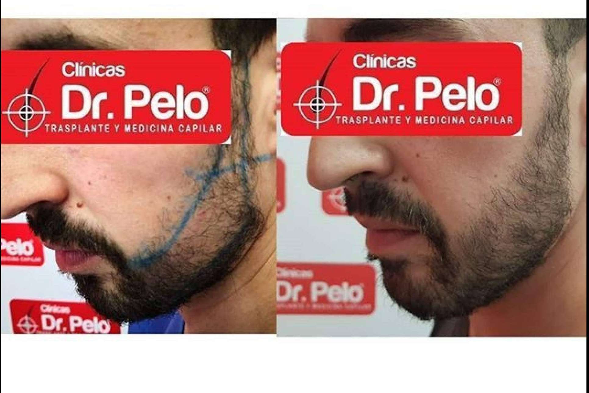 Clínicas Dr. Pelo: el trasplante de barba, uno de los tratamientos con resultados más satisfactorios