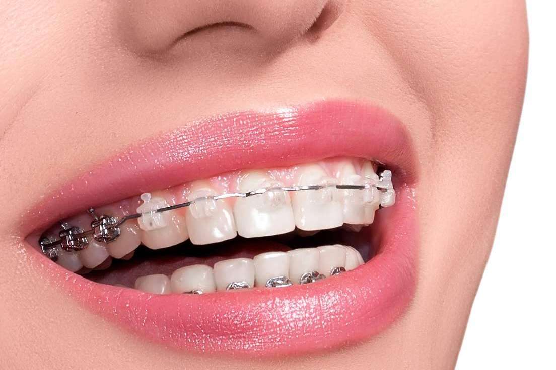 Las ventajas del tratamiento de ortodoncia con brackets, por Helident Clínica Dental