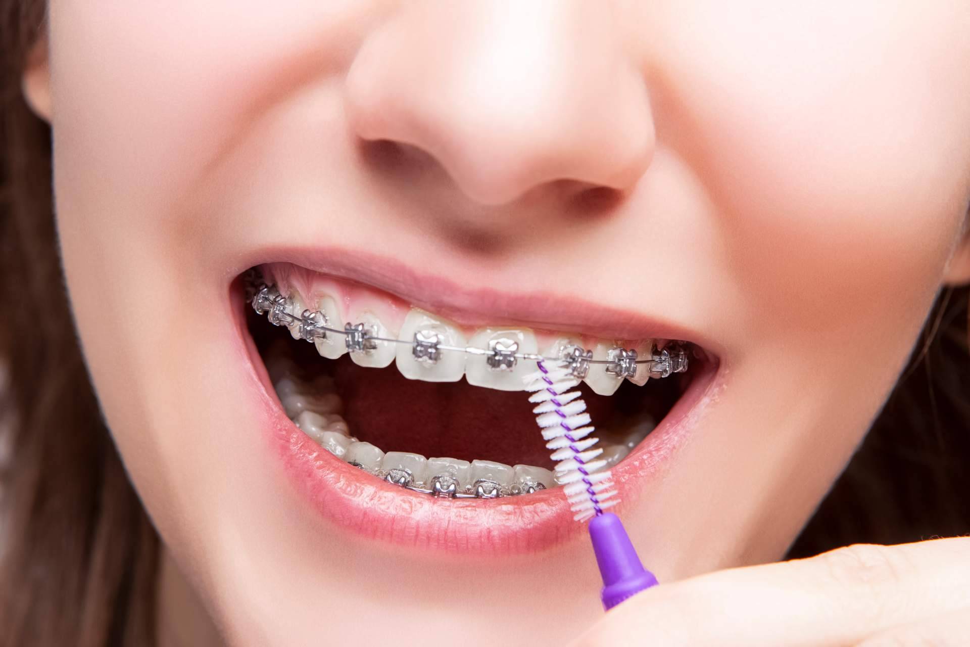 Clínica Sonrisas, en Badajoz, ofrece servicios de ortodoncia Insignia