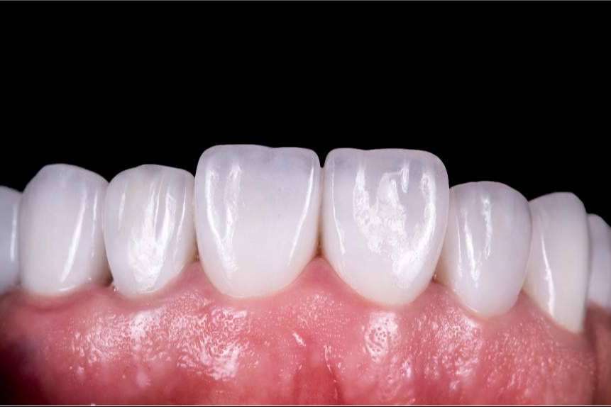 Implantes dentales innovadores con Clínicas Qualident en Hospitalet