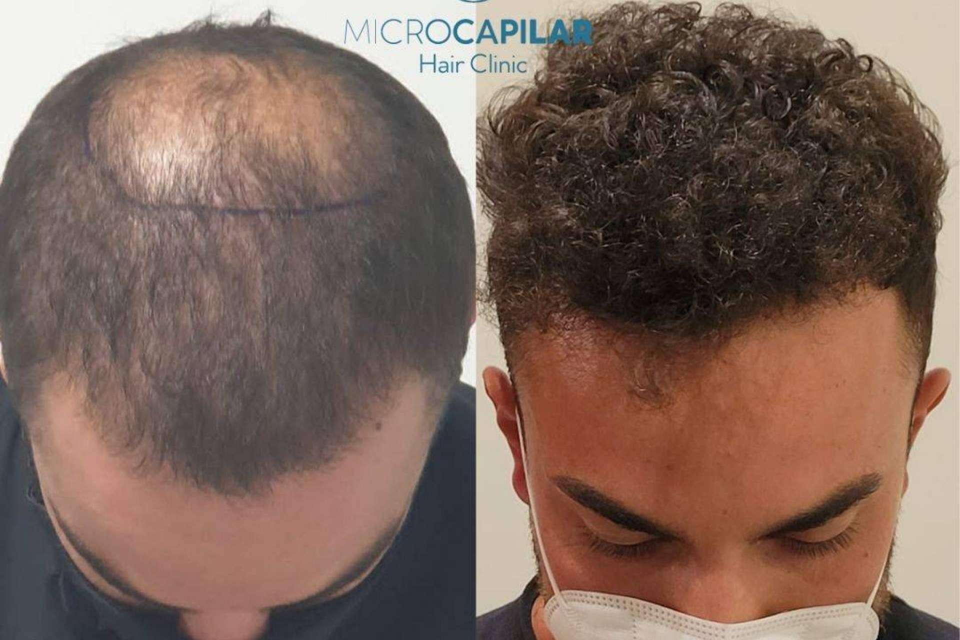 ¿Dónde realizarse un injerto capilar con máxima extracción folicular? Microcapilar Hair Clinic