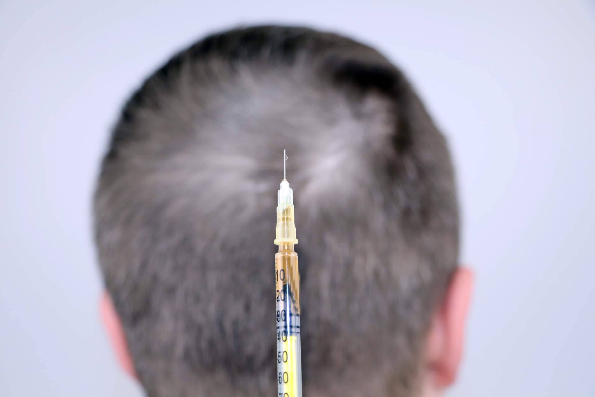 El tratamiento de mesoterapia capilar que realiza el Dr. Bruno Jacobovski para el cuidado profundo del cuero cabelludo ante la caída del cabello