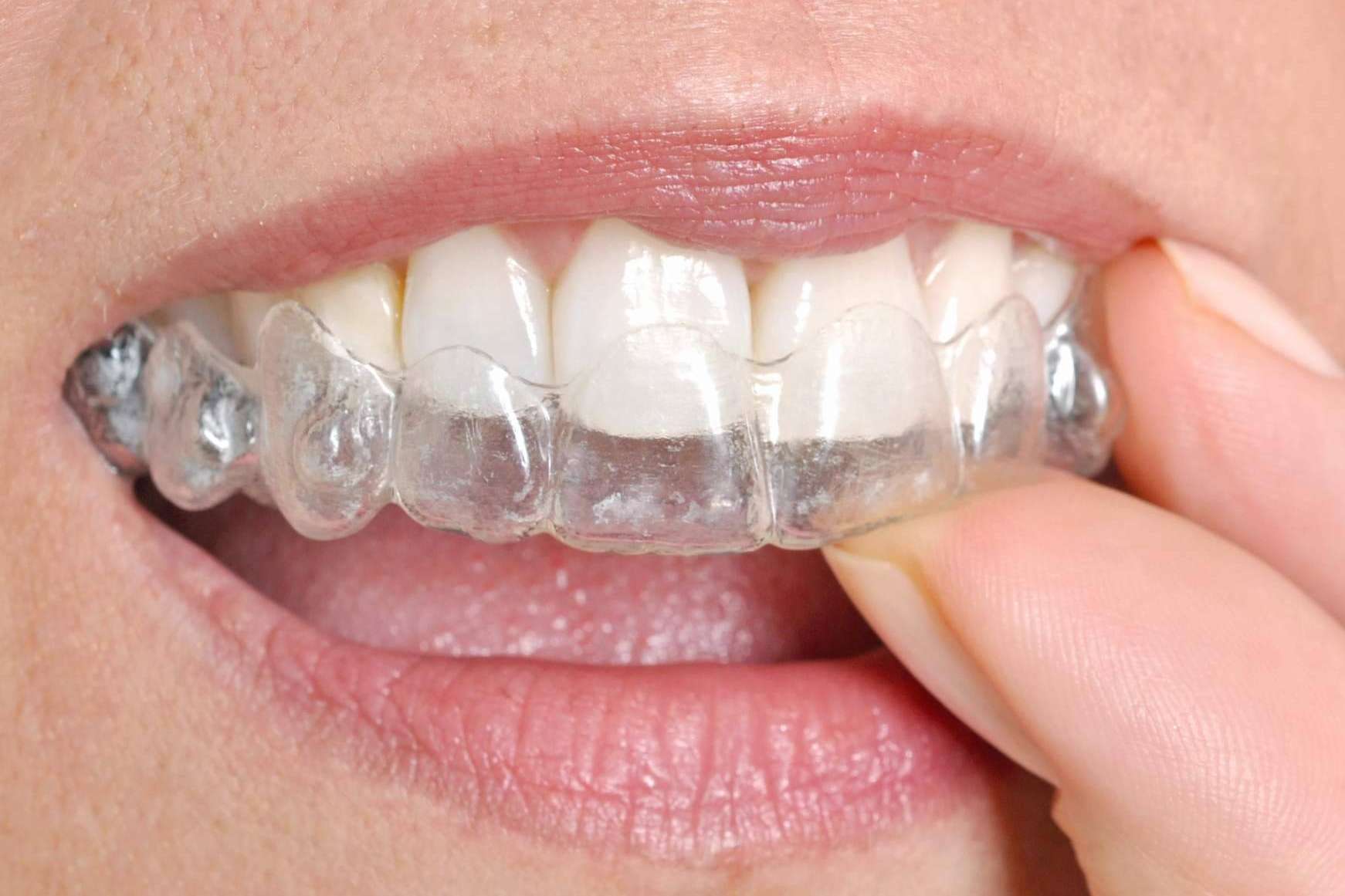 Los centros recomendados con servicios de ortodoncia invisible son distinguidos por el Certificado de Calidad DentalQuality®