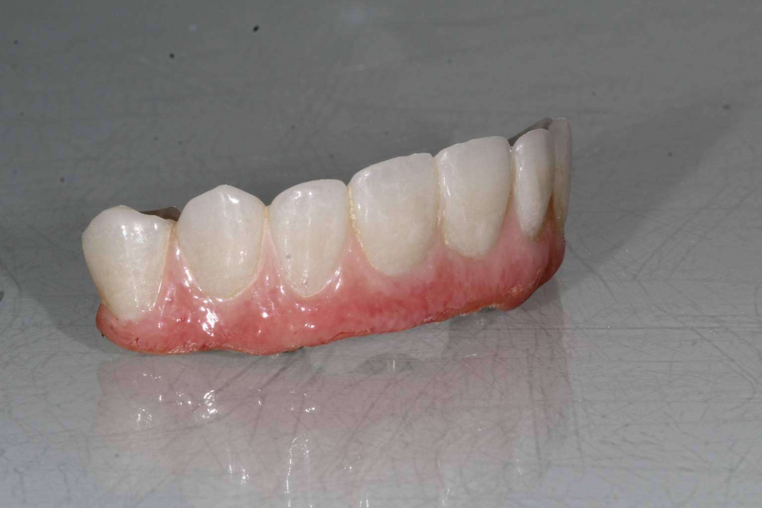 ¿Cuáles son los beneficios del tratamiento ALL ON 4 de Implant Clinics?