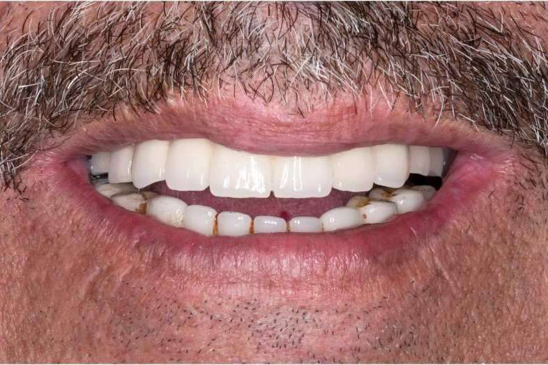Rehabilitaciones orales complejas en un día en la clínica dental en Madrid Bordonclinic
