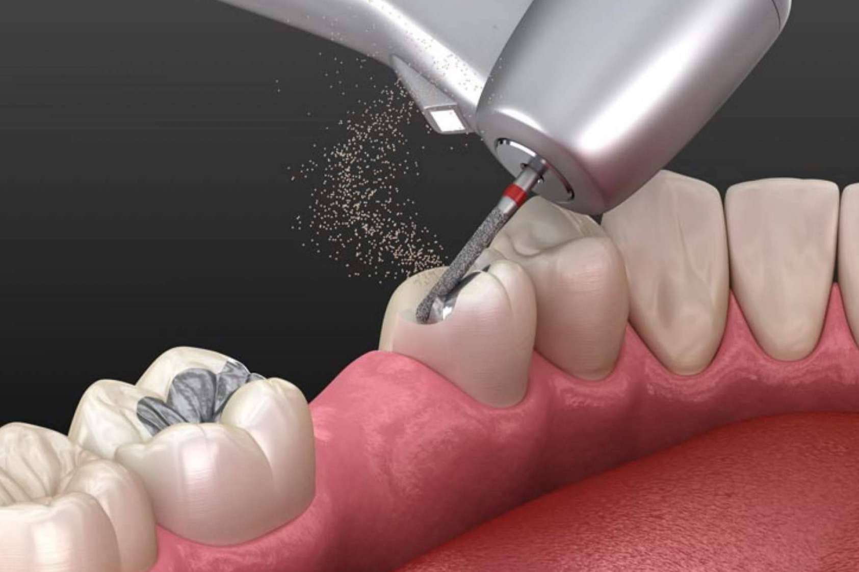 La calidad de las fresas dentales ayuda a que el instrumento dure más tiempo, según Precisión Médica Dental