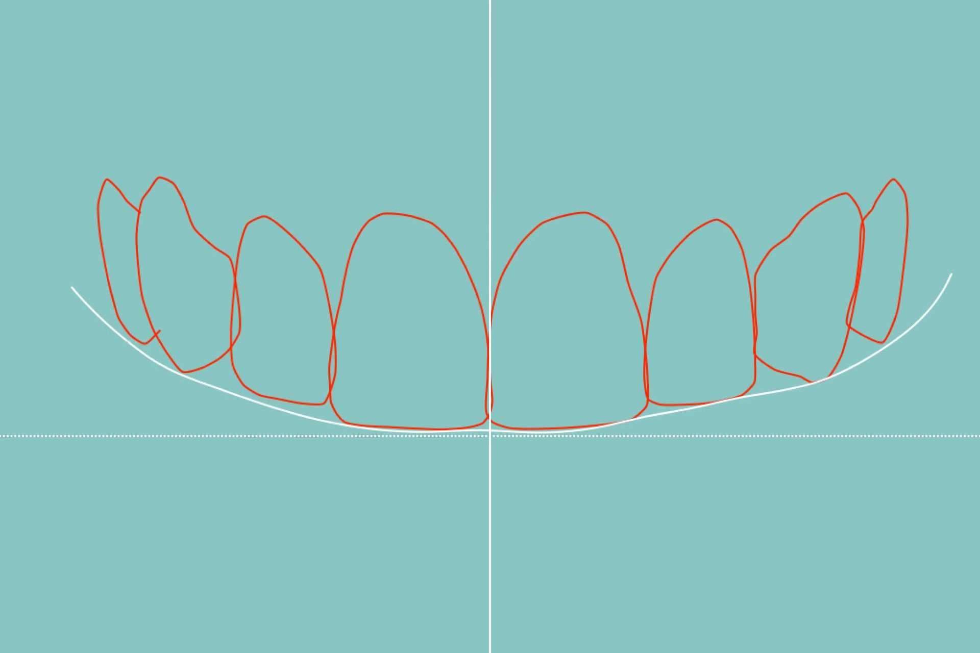 Tecnología de vanguardia para el diseño de sonrisa de la mano de Clínica Dental Blay + Monzó