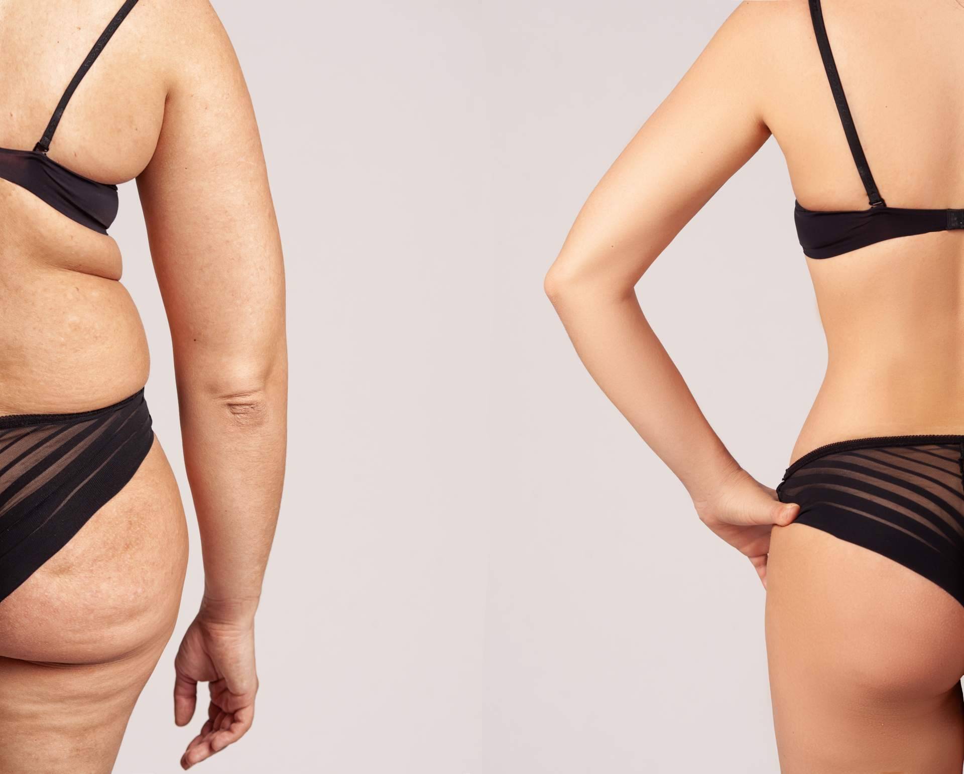 Los beneficios del tratamiento de Velashape III de la Dra. Rigo