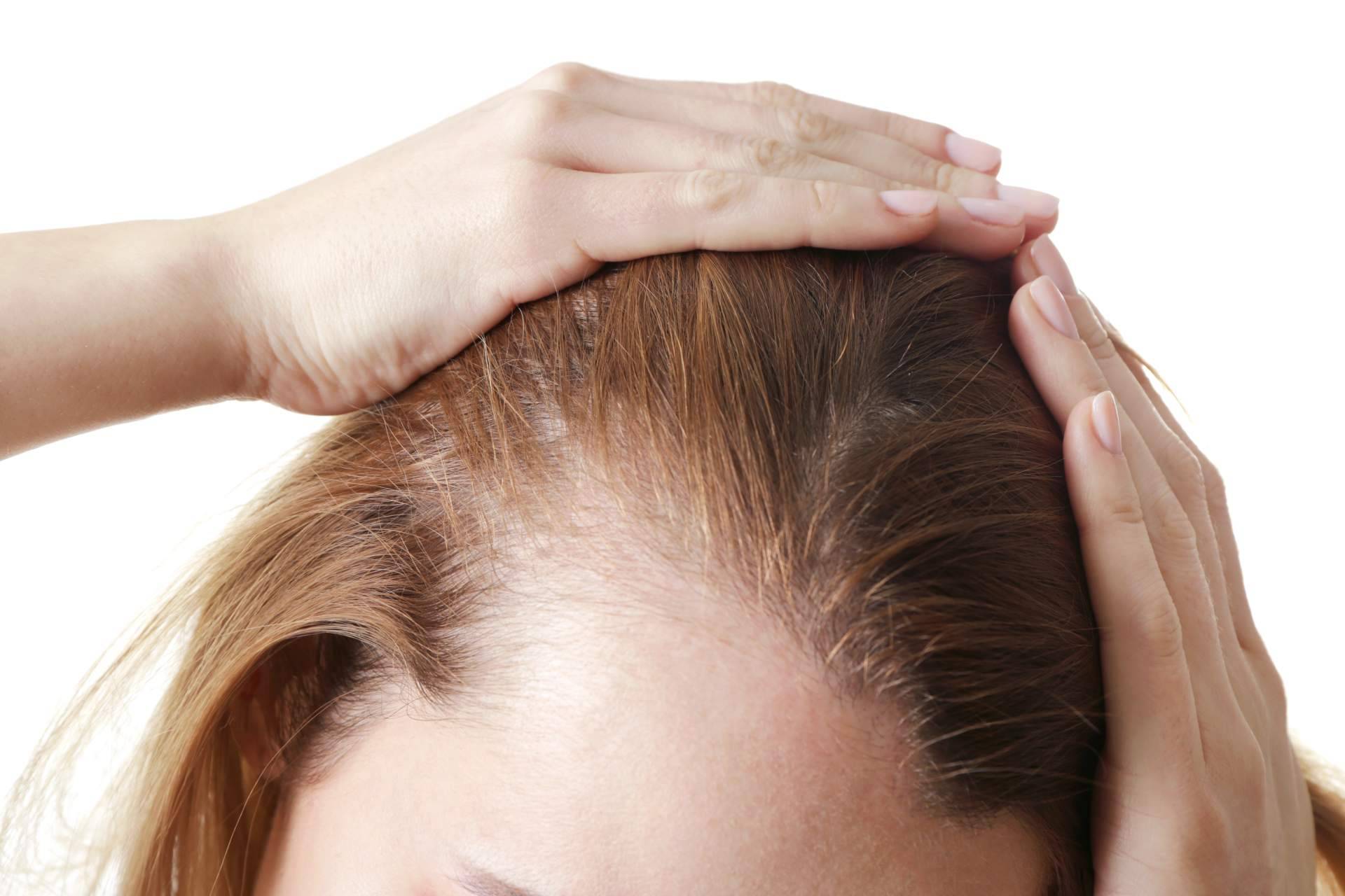 Las mujeres también sufren alopecia, por Clínica Femme
