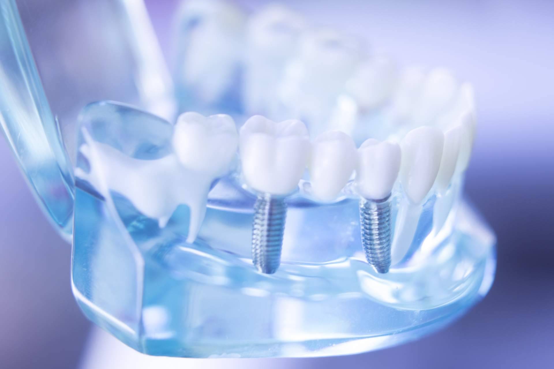 La clínica Corrales Dental es especialista en colocar implantes cigomáticos