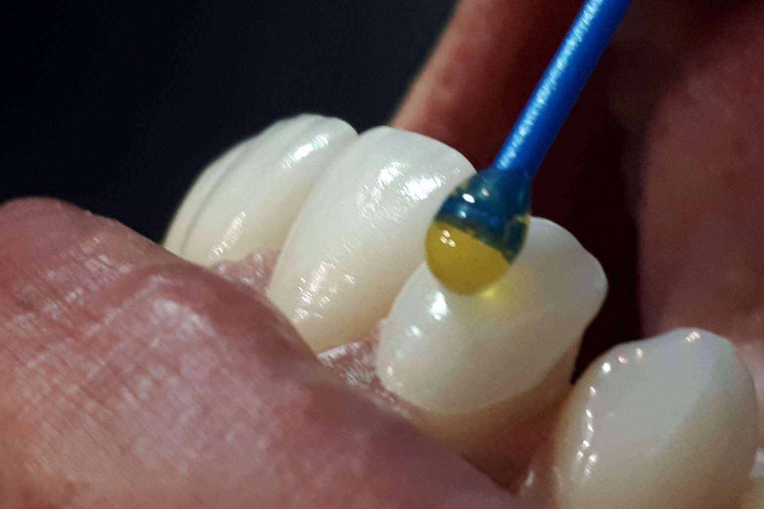 Coronas dentarias impresas con tecnología 3D en una hora de la mano de Dentinova