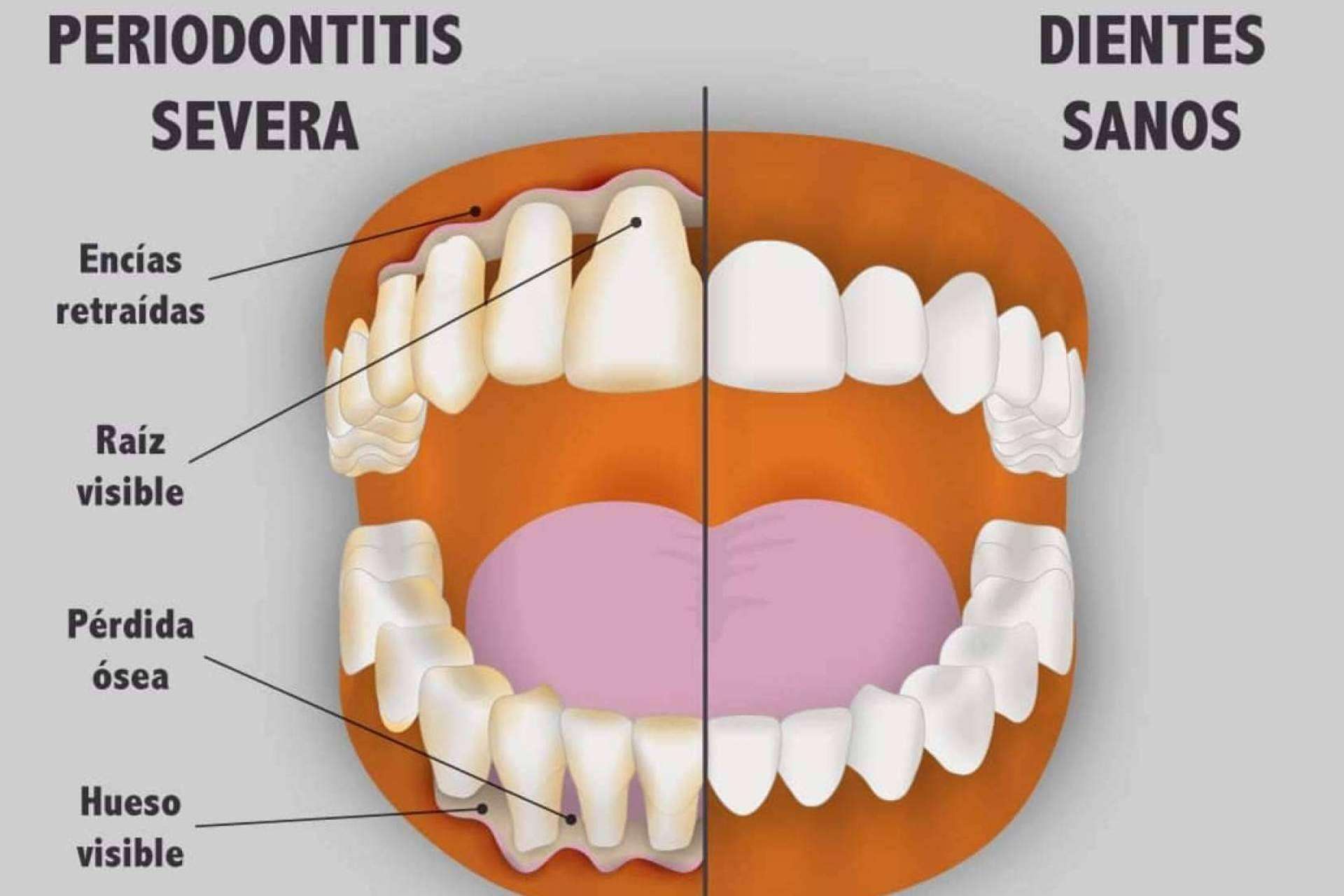 Implant Clinics explica qué es una enfermedad periodontal y cómo se debe tratar
