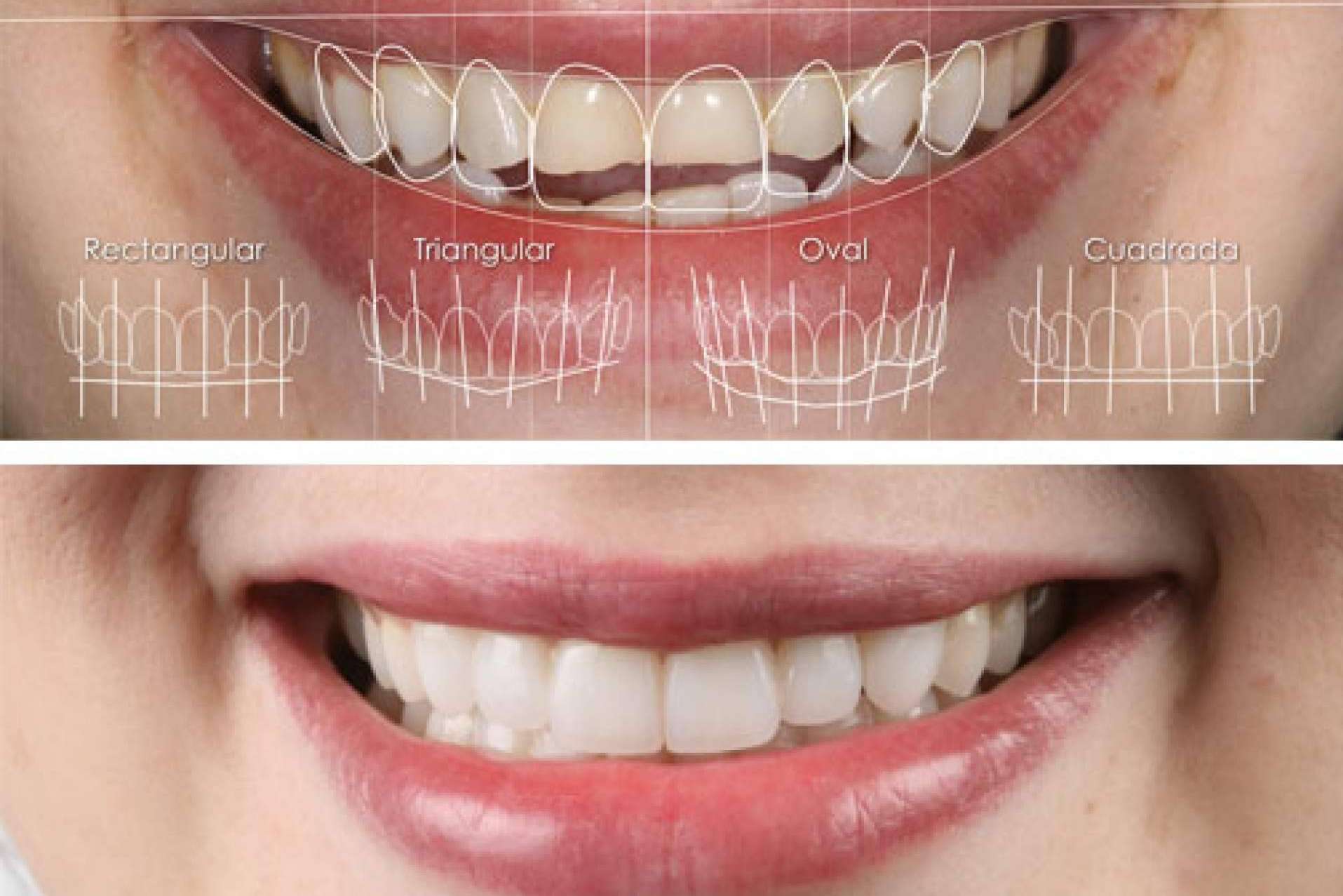 Clínica Dental Ruiz de Gopegui y las carillas dentales, uno de los recursos favoritos por los expertos en estética dental