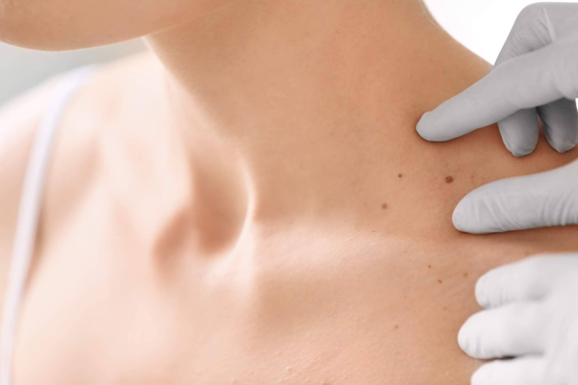 ¿Cómo tratar y prevenir las manchas en la piel en verano?, de la mano de Farmacia Laura Garín