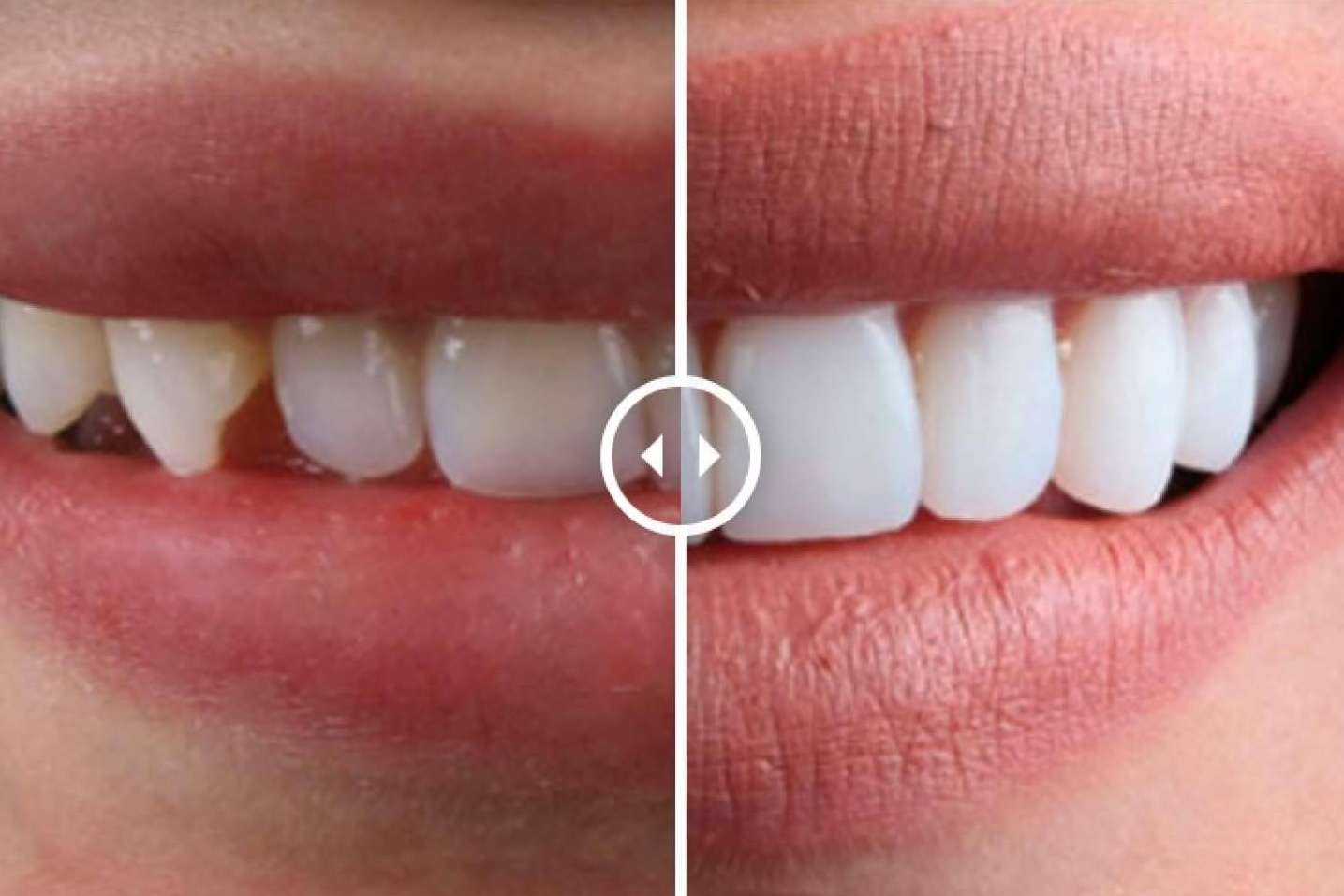 Todo lo que se debe saber sobre las carillas dentales, por Crespí & Gandía