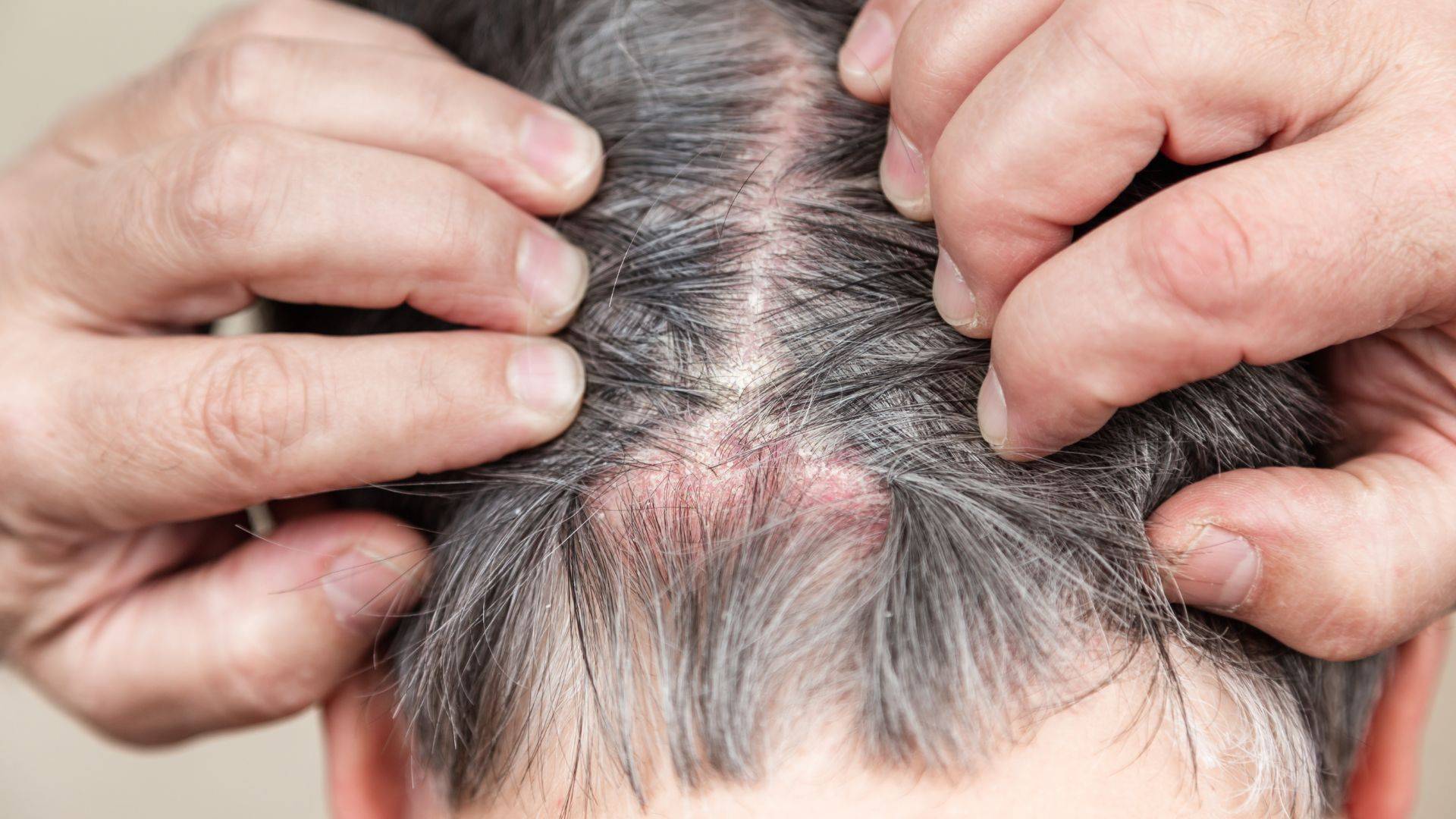 ¿Pueden contagiar los perros la alopecia por tiña del cuero cabelludo?