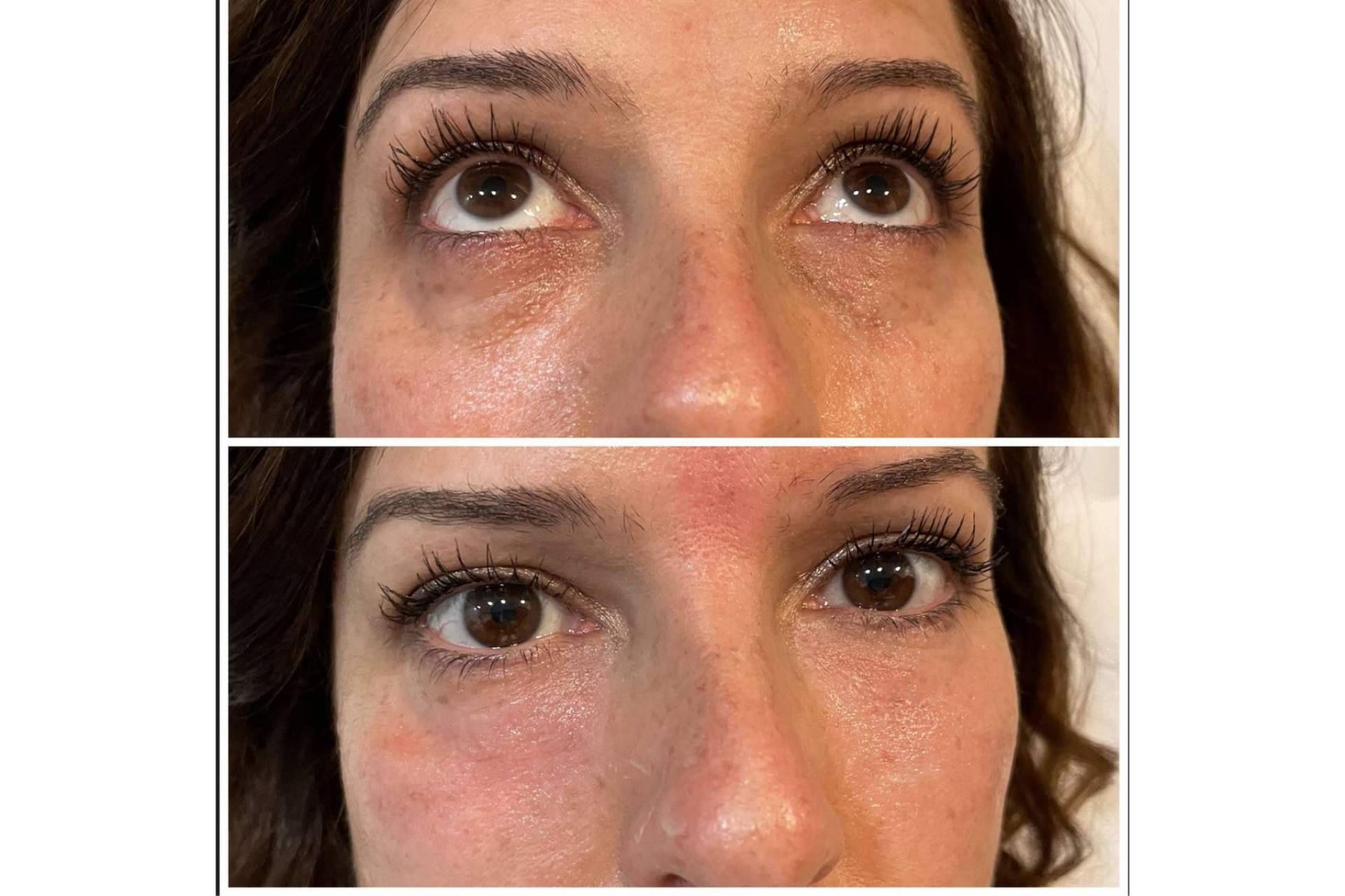 Despertar la mirada con el tratamiento de relleno de ojeras con ácido hialurónico de Cecilia Arthur