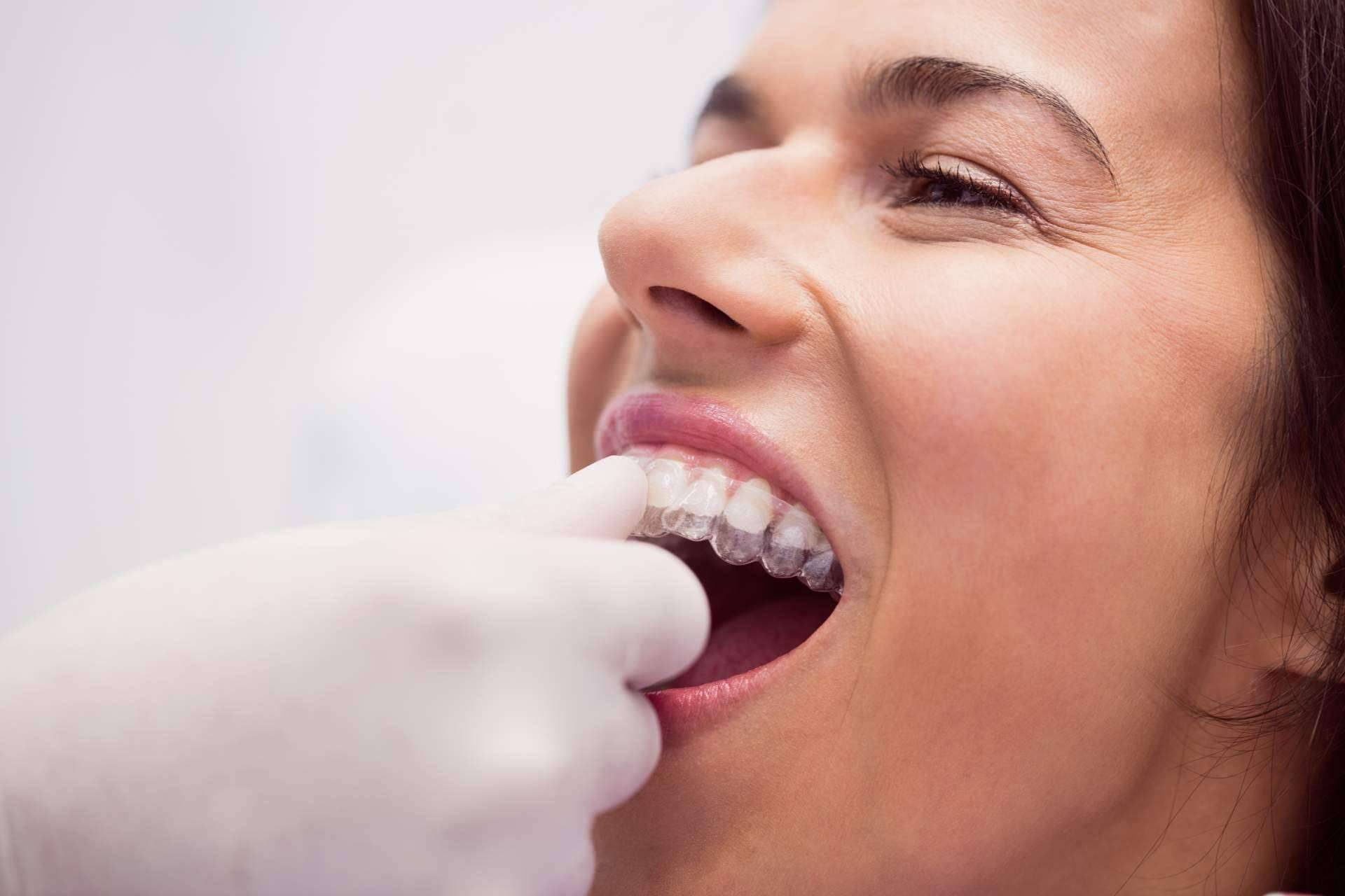 Toda la información acerca de la ortodoncia para adultos, por Clínica Dental Delgado