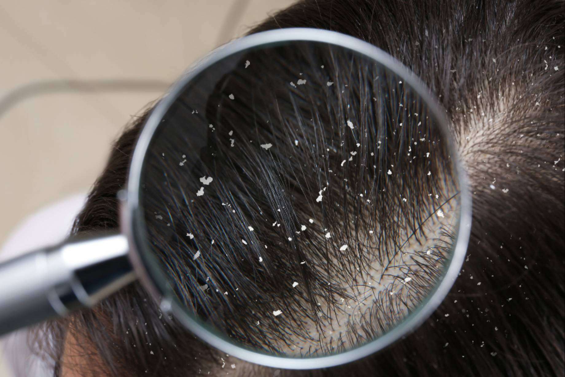 ¿Es culpable la caspa de la caída del cabello?