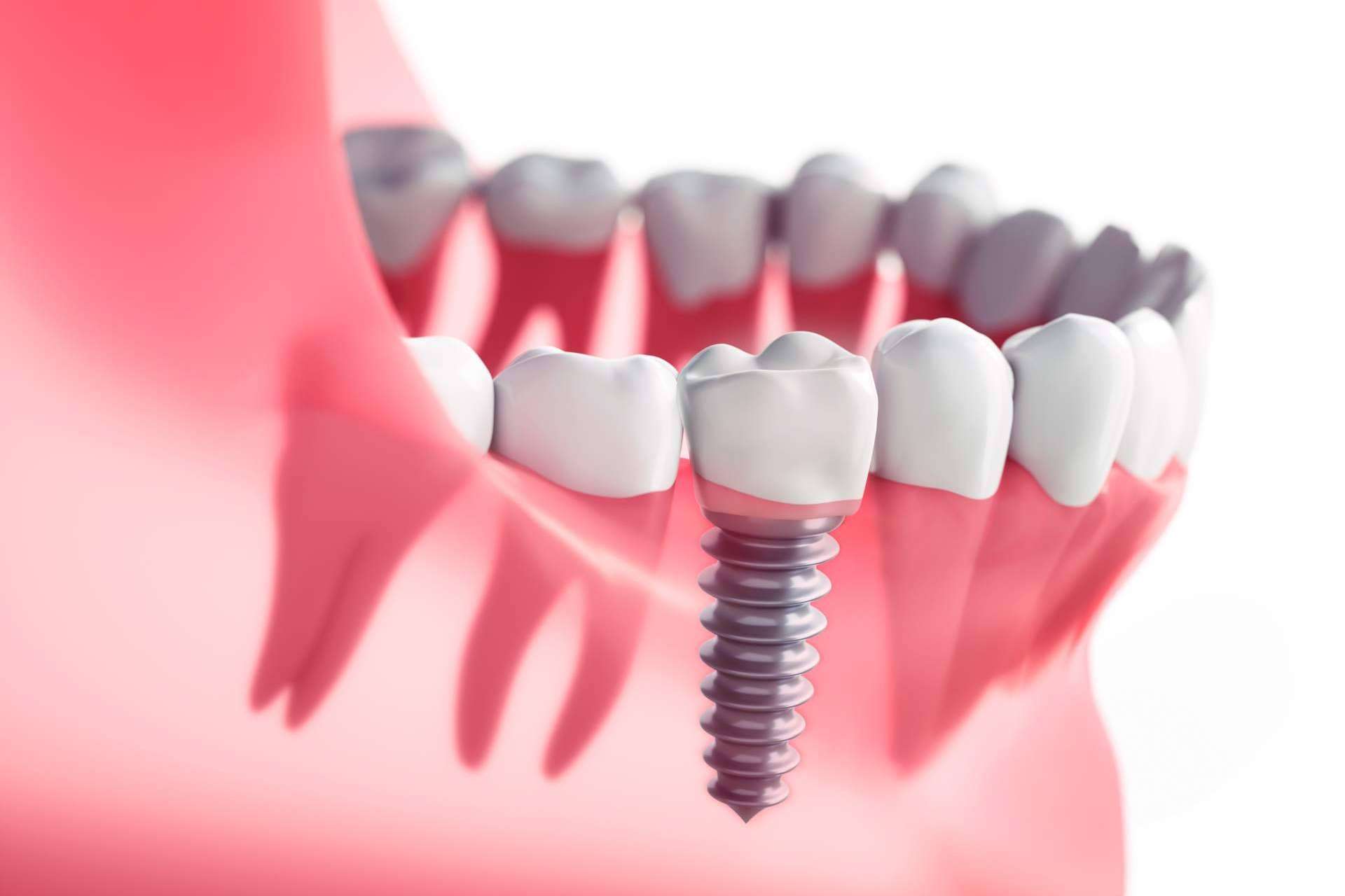 Los tipos de implantes dentales que existen y cuál usar según las necesidades, por DeltaDent