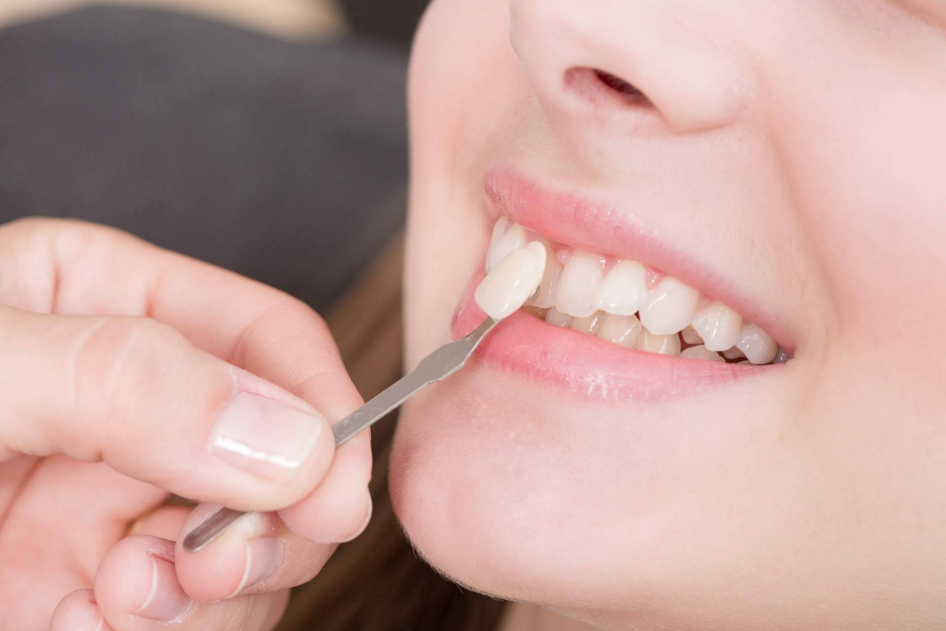 Clínica Dental Delgado mejora la sonrisa de sus pacientes con carillas dentales