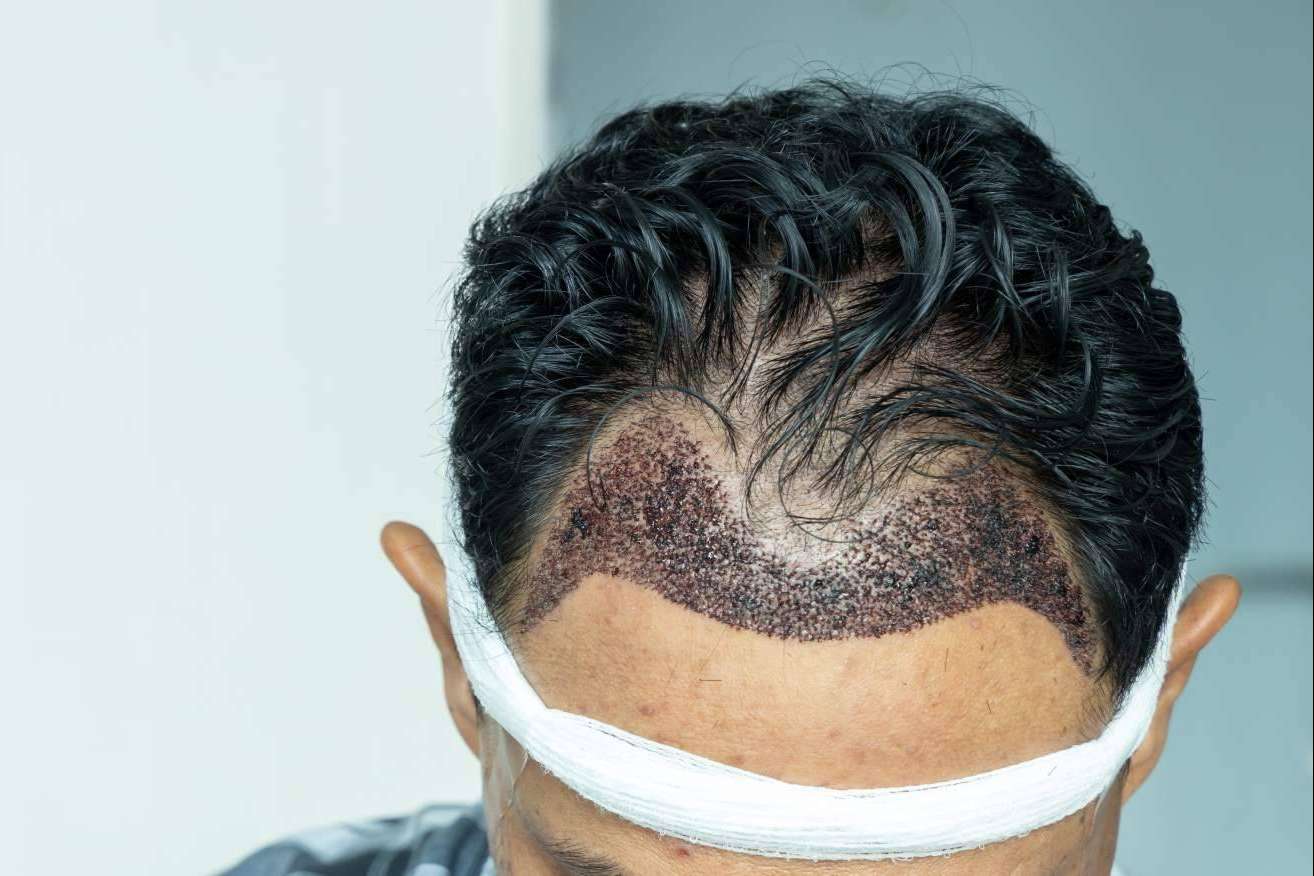 MC360 recalca que el éxito de un injerto capilar depende de su buen diseño