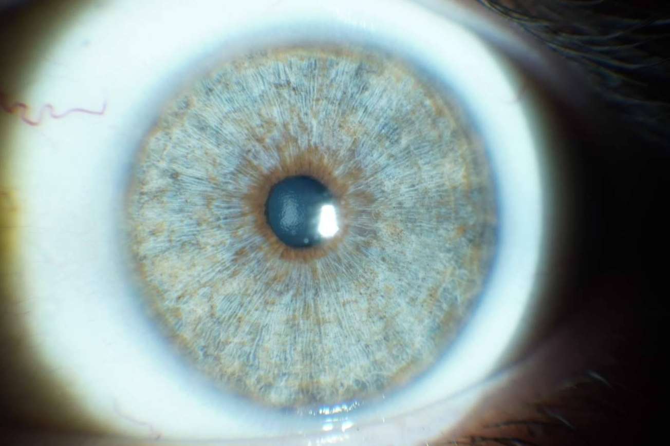 Los avances en las operaciones de cambio de color de ojos con láser, de la mano de Clínica Eyecos