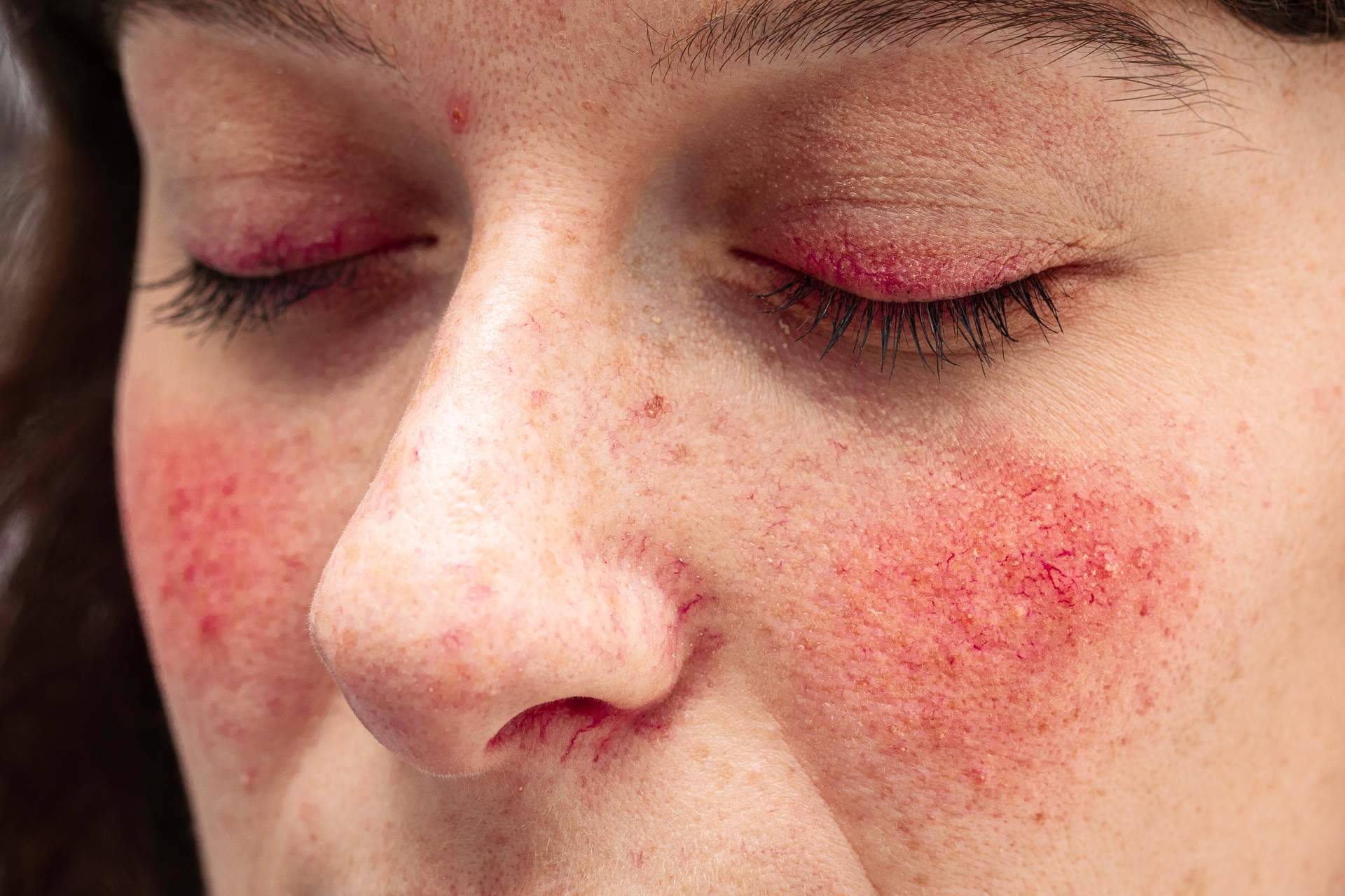 ¿Cómo hay que cuidar correctamente la rosácea? Los expertos de La Para-Farmacia del Puerto