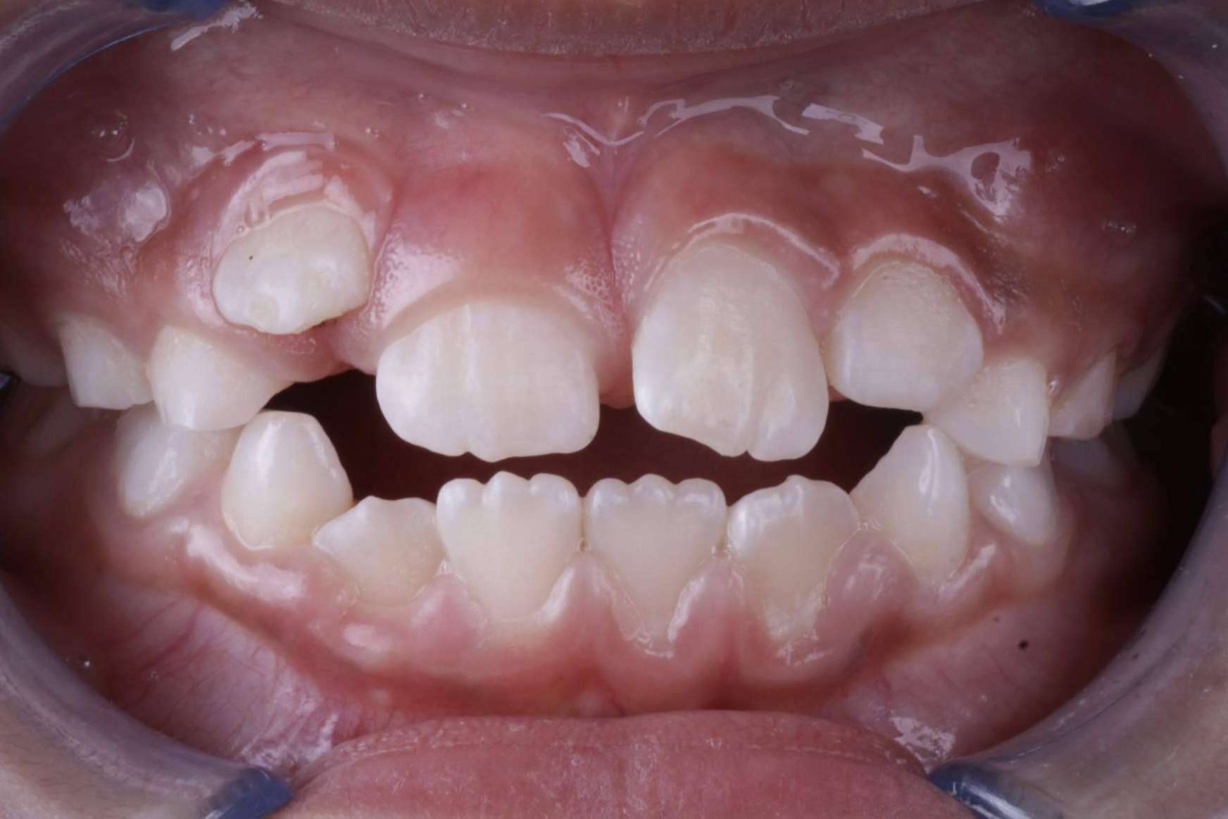 Tratamientos de odontología infantil en la Clínica Los Llanos Dental en Barcelona