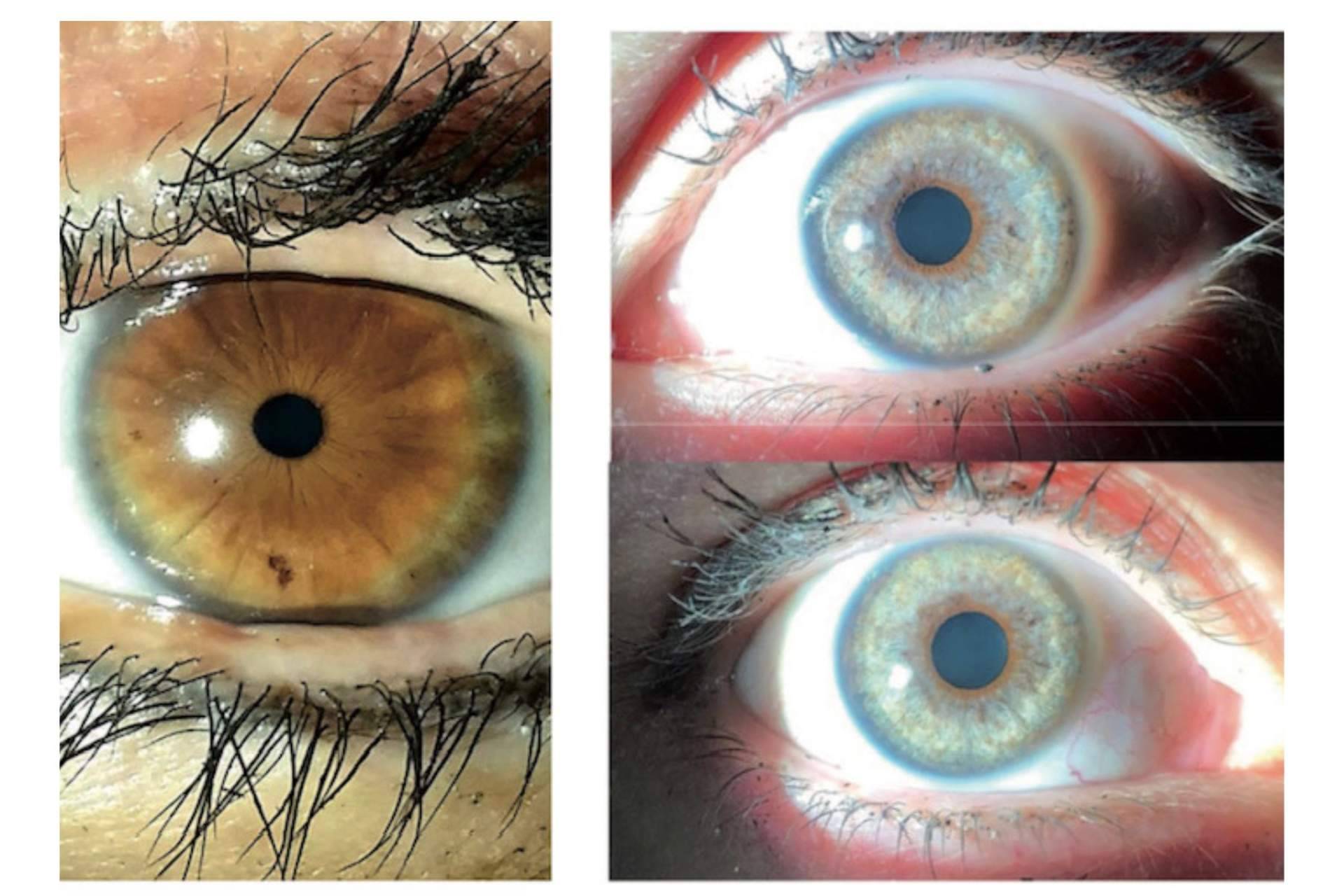 Clínica Eyecos expone que los productos crece pestañas pueden ocasionar un oscurecimiento de los ojos