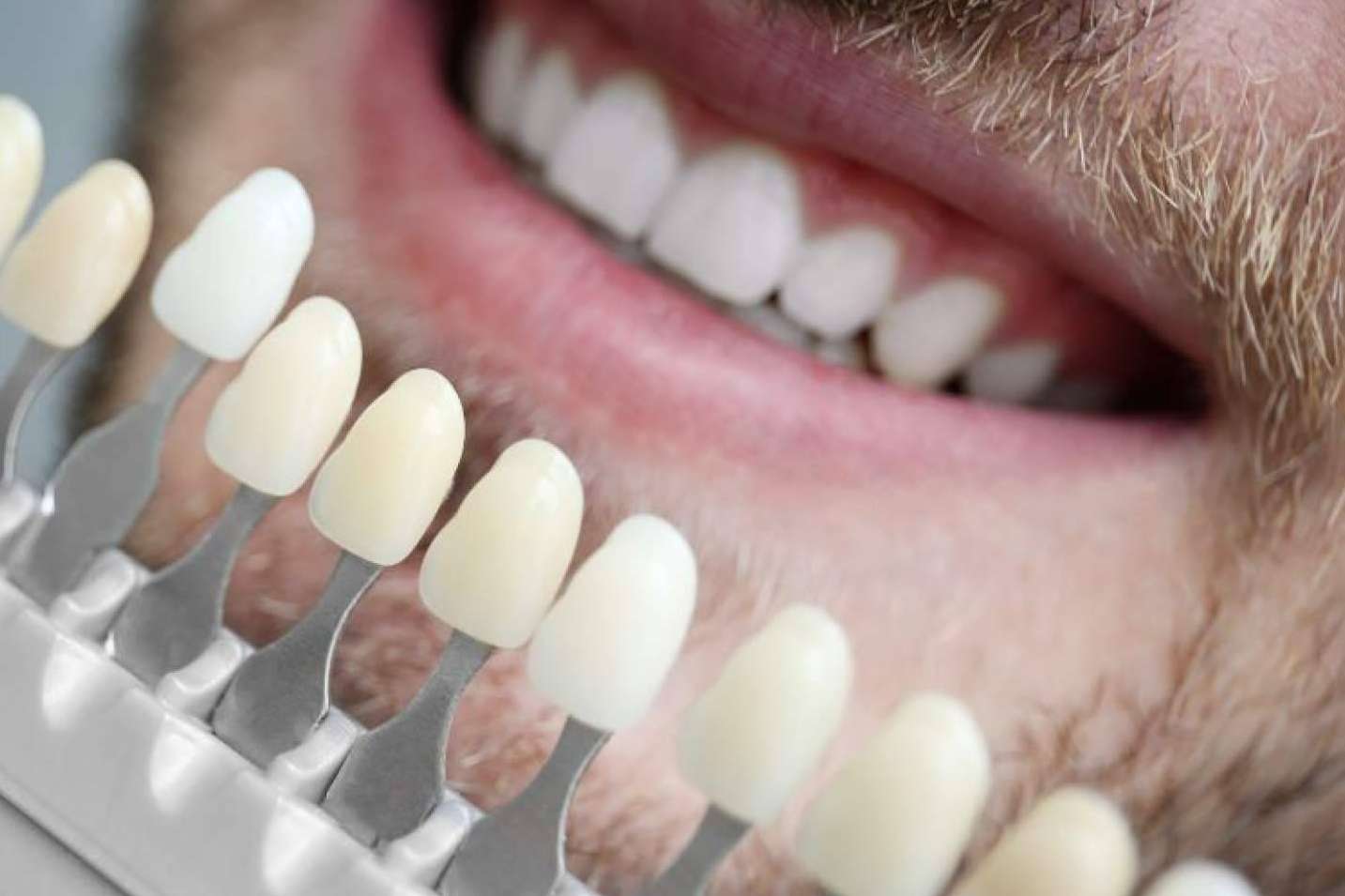 Clínica Dental Ruiz de Gopegui explica los beneficios de las carillas de composite