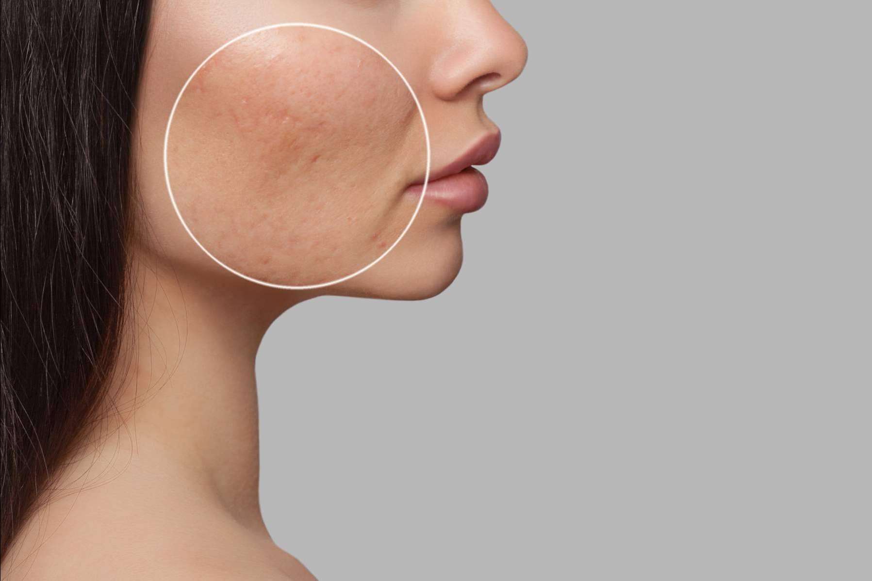 Tratamiento de cicatrices de acné con radiofrecuencia fraccionada con microagujas, de la mano de Alluring Clinic