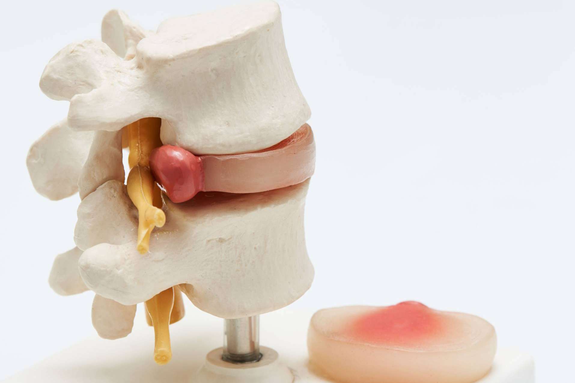 La andulación, un enfoque terapéutico innovador para casos de hernia discal