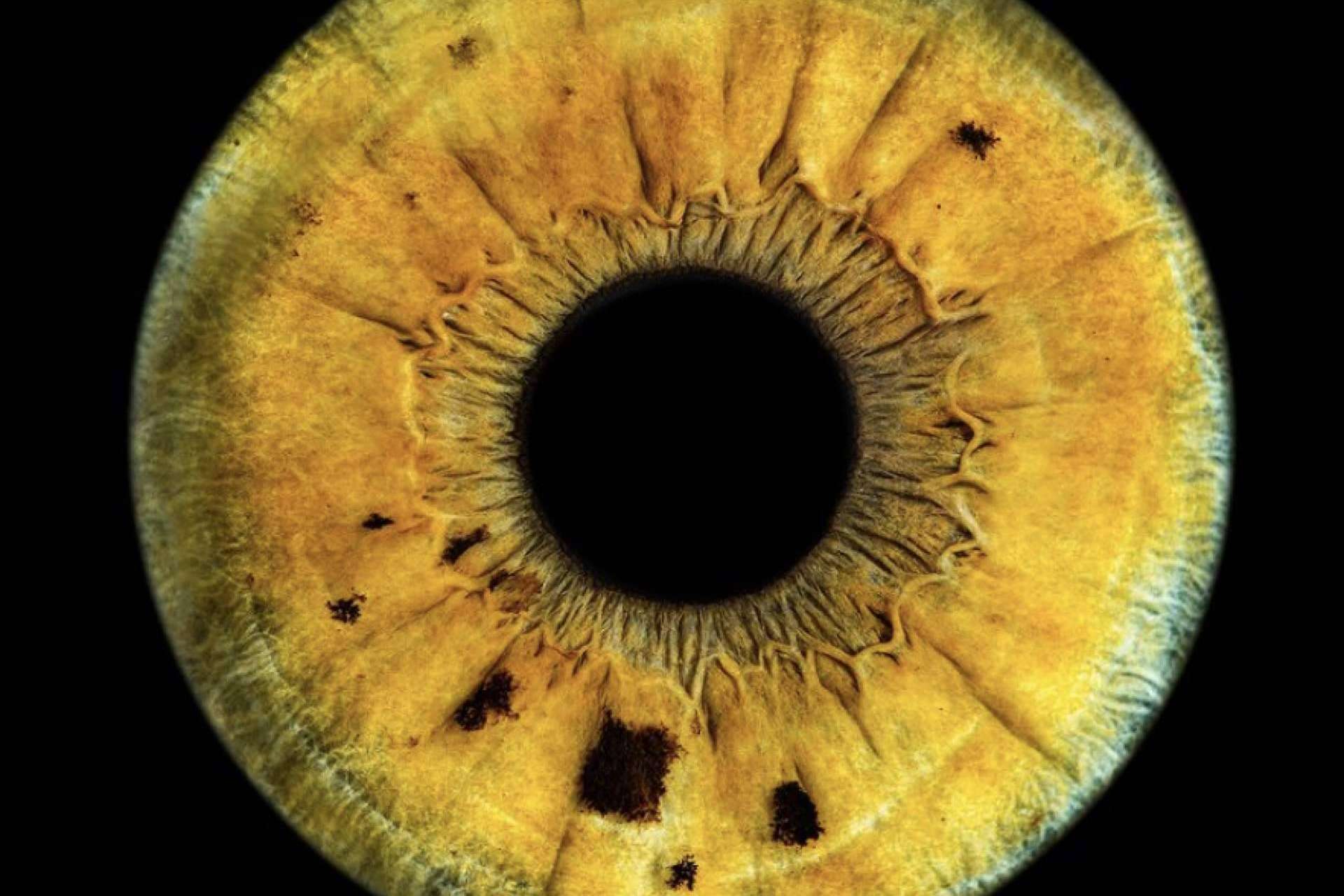 Perfil psicológico sano de los pacientes que llevan a cabo el láser de cambio de color de ojos